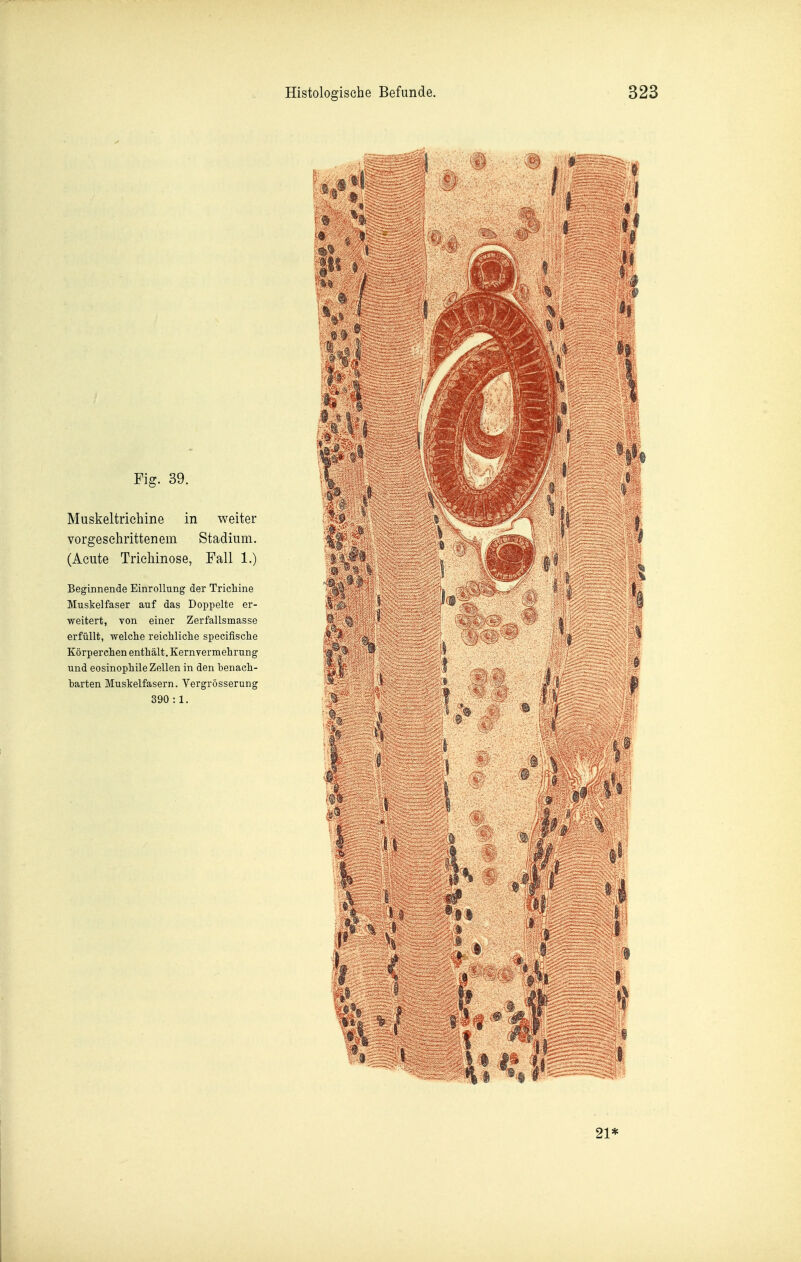 Fig. 39. Miiskeltriehine in weiter vorgeschrittenem Stadium. (Acute Trichinose, Fall 1.) Beginnende Einrollung der Trichine Muskelfaser auf das Doppelte er- weitert, von einer Zerfallsmasse erfüllt, welche reichliche specifische Körperchen enthält. Kern Vermehrung und eosinophile Zellen in den benach- barten Muskelfasern. Vergrösserung 390:1. Histologische Befunde. 323 21*