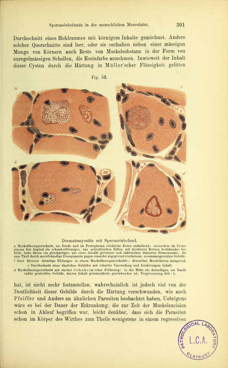 Durchschnitt eines Hohh'aumes mit körnigem Inhalte gezeichnet. Andere solcher Querschnitte sind leer, oder sie enthalten neben einer massigen Menge von Körnern auch Eeste von Muskelsubstanz in der Form von unregelmässigen Schollen, die Eosinfarbe annehmen. Inwieweit der Inhalt dieser Cysten durch die Härtung in Müller'scher Flüssigkeit gelitten Fig. 53. Dermatorayositis mit Sporozoönbefund. a Muskelfaserquersclinitt, am Rande und im Protoplasma reicliliche Kerne enthaltend: ausserdem im Proto- plasma frei liegend ein schmal-eiförmiges, aus polyedrischen Zellen mit dunkleren Kernen hestehendes Ge- bilde, links davon ein gleichartiges, aus einer Anzahl grösserer und zahlreichen kleineren Elemementen, die zum Theil durch unvollständige Dissepimente gegen einander abgegrenzt erscheinen, zusammengesetztes Gebilde. Zwei kleinere derartige Bildungen in einem Muskelfaserquerschnitte; demselben Muskelkerne anlagernd, c Durchschnitt eines ähnlichen Gebildes mit scharfer Umrandung und feinkörnigem Inhalt. d Muskelfaserquerschnitt mit starker C o h nh e im'scher Felderung; in der Mitte ein dreieckiges, am Kande radiär gestreiftes Gebilde, dessen Inhalt grösstentheils geschwunden ist. Vergrösserung 500 : 1. hat, ist nicht mehr festzustellen, wahrscheinlich ist jedoch viel von der Deutlichkeit dieser Gebilde durch die Härtung verschwunden, wie auch Pfeiffer und Andere an ähnlichen Parasiten beobachtet haben. Uebrigens wäre es bei der Dauer der Erkrankung, die zur Zeit der Muskelexcision schon in Ablauf begriffen war, leicht denkbar, dass sich die Parasiten schon im Körper des Wirthes zum Theile wenigstens in einem regressiven