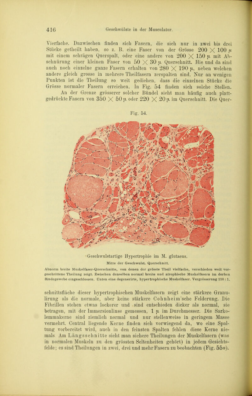 Vierfache. Dazwischen finden sich Fasern, die sich nur in zwei bis drei Stücke getheilt haben, so z. B. eine Faser von der Grösse 200 X 100 mit einem schrägen Querspalt, oder eine andere von 200 X 150 [jl mit Ab- schnürung einer kleinen Faser von 50 X 30 [x Querschnitt. Hie und da sind auch noch einzelne ganze Fasern erhalten von 280 X 190 [i, neben welchen andere gleich grosse in mehrere Theilfasern zerspalten sind. Nur an wenigen Punkten ist die Theilung so weit gediehen, dass die einzelnen Stücke die Grösse normaler Fasern erreichen. In Fig. 54 finden sich solche Stellen. An der Grenze grösserer solcher Bündel sieht man häufig auch platt- gedrückte Fasern von 350 X 50 {X oder 220 X 20 [i. im Querschnitt. Die Quer- Fig. 54. Gesehwiüstartige Hypertrophie im M. glutaeus. Mitte der Geschwulst. Querschnitt. Abnorm breite Muskelfaser-Querschnitte, von denen der grösste Theil vielfache, verschieden weit vor- geschrittene Theilung zeigt. Zwischen denselben normal breite und atrophische Muskelfasern im derben Bindegewebe eingeschlossen. Unten eine degenerirte, hypertrophische Muskelfaser. Vergrösserung 110 : 1. Schnittsfläche dieser hypertrophischen Muskelfasern zeigt eine stärkere Granu- lirung als die normale, aber keine stärkere Cohnheim'sche Felderung. Die Fibrillen stehen etwas lockerer und sind entschieden dicker als normal, sie betragen, mit der Immersionlinse gemessen, 1 [x im Durchmesser. Die Sarko- lemmakerne sind ziemlich normal und nur stellenweise in geringem Masse vermehrt. Central liegende Kerne finden sich vorwiegend da, wo eine Spal- tung vorbereitet wird, auch in den feinsten Spalten fehlen diese Kerne nie- mals. Am Längsschnitte sieht man sichere Theilungen der Muskelfasern (was in normalen Muskeln zu den grössten Seltenheiten gehört) in jedem Gesichts- felde ; es sind Theilungen in zwei, drei und mehr Fasern zu beobachten (Fig. 55a).