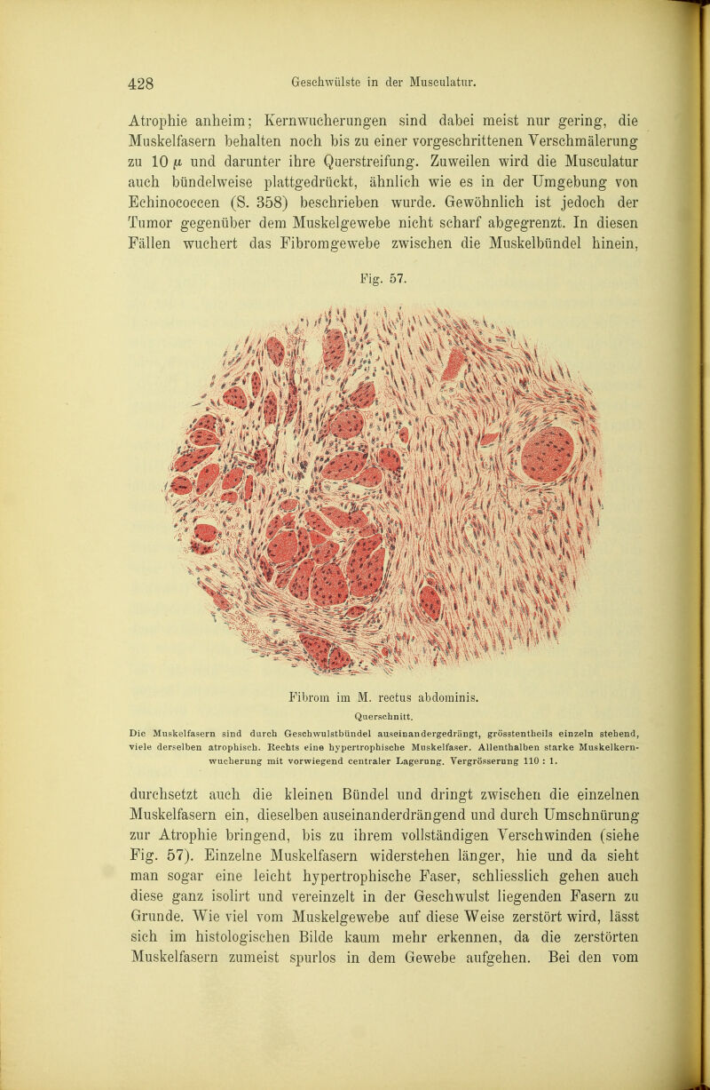 Atrophie anheim; Kernwucherungen sind dabei meist nur gering, die Muskelfasern behalten noch bis zu einer vorgeschrittenen Verschmälerung zu 10 ii und darunter ihre Querstreifung. Zuweilen wird die Museulatur auch bündelweise plattgedrückt, ähnlich wie es in der Umgebung von Echinocoecen (S. 358) beschrieben wurde. Gewöhnlich ist jedoch der Tumor gegenüber dem Muskelgewebe nicht scharf abgegrenzt. In diesen Fällen wuchert das Fibromgewebe zwischen die Muskelbündel hinein, Fig. 57. Fibrom im M. reetus abdominis. Querschnitt. Die Muskelfasern sind durch Geschwulstbiindel auseinandergedrängt, grösstentheils einzeln stehend, viele derselben atrophisch. Rechts eine hypertrophische Muskelfaser. Allenthalben starke Muskelkern- wucherung mit vorwiegend centraler Lagerung. Vergrösserung 110 : 1. durchsetzt auch die kleinen Bündel und dringt zwischen die einzelnen Muskelfasern ein, dieselben auseinanderdrängend und durch Umschnürung zur Atrophie bringend, bis zu ihrem vollständigen Verschwinden (siehe Fig. 57). Einzelne Muskelfasern widerstehen länger, hie und da sieht man sogar eine leicht hypertrophische Paser, schliessUch gehen auch diese ganz isolirt und vereinzelt in der Geschwulst liegenden Fasern zu Grunde. Wie viel vom Muskelgewebe auf diese Weise zerstört wird, lässt sich im histologischen Bilde kaum mehr erkennen, da die zerstörten Muskelfasern zumeist spurlos in dem Gewebe aufgehen. Bei den vom