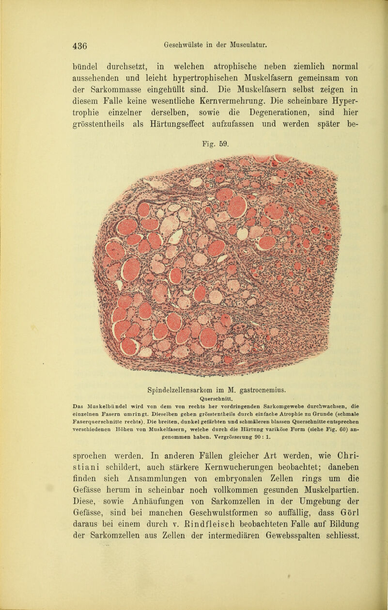 bündel durchsetzt, in welchen atrophische neben ziemlich normal aussehenden und leicht hypertrophischen Muskelfasern gemeinsam von der Sarkommasse eingehüllt sind. Die Muskelfasern selbst zeigen in diesem Falle keine wesentliche Kernvermehrung. Die scheinbare Hyper- trophie einzelner derselben, sowie die Degenerationen, sind hier grösstentheils als Härtungseffect aufzufassen und werden später be- Fig. 59. Spindelzellensarkom im M. gastrocnemius. Querschnitt, Das Muskelbündel -wird von dem von rechts her vordringenden Sarkomgewebe durchwachsen, die einzelnen Fasern umringt. Dieselben gehen grösstenibeils durch einfache Atrophie zu Grunde (schmale Taserquerschnitte rechts). Die breiten, dunkel gefärbten und schmäleren blassen Querschnitte entsprechen verschiedenen Höhen von Muskelfasern, welche durch die Härtung variköse Form (siehe Fig. 60) an- genommen haben. Vergrösserung 90: 1. sprochen werden. In anderen Fällen gleicher Art werden, wie Ohri- stiani schildert, auch stärkere Kernwucherungen beobachtet; daneben finden sich Ansammlungen von embryonalen Zellen rings um die Gefässe herum in scheinbar noch vollkommen gesunden Muskelpartien. Diese, sowie Anhäufungen von Sarkomzellen in der Umgebung der Gefässe, sind bei manchen Geschwulstformen so aufi'ällig, dass Görl daraus bei einem durch v. Rindfleisch beobachteten Falle auf Bildung der Sarkomzellen aus Zellen der intermediären Gewebsspalten schliesst.
