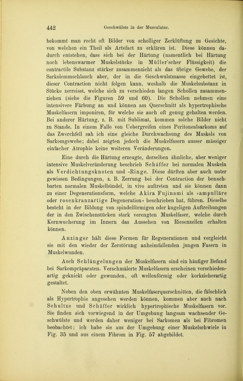 bekommt man recht oft Bilder von scholliger Zerklüftung zu Gesichte, von welchen ein Theil als Artefact zu erklären ist. Diese können da- durch entstehen, dass sich bei der Härtung (namenthch bei Härtung noch lebenswarmer Muskelstücke in Müller'scher Flüssigkeit) die contractile Substanz stärker zusammenzieht als das übrige Gewebe, der Sarkolemmschlauch aber, der in die Geschwulstmasse eingebettet ist, dieser Contraction nicht folgen kann, weshalb die Muskelsubstanz in Stücke zerreisst, welche sich zu verschieden langen Schollen zusammen- ziehen (siehe die Figuren 59 und 60). Die Schollen nehmen eine intensivere Färbung an und können am Querschnitt als hypertrophische Muskelfasern imponiren, für welche sie auch oft genug gehalten werden. Bei anderer Härtung, z. B. mit Sublimat, kommen solche Bilder nicht zu Stande. In einem Falle von Uebergreifen eines Peritonealsarkoms auf das Zwerchfell sah ich eine gleiche Durchwachsung des Muskels von Sarkomgewebe; dabei zeigten jedoch die Muskelfasern ausser mässiger einfacher Atrophie keine weiteren Veränderungen. Eine durch die Härtung erzeugte, derselben ähnliche, aber weniger intensive Muskelveränderung beschrieb Schäffer bei normalen Muskeln als Yerdichtungsknoten und -Einge. Diese dürften aber auch unter gewissen Bedingungen, z. B. Zerrung bei der Contraction der benach- barten normalen Muskelbündel, in vivo auftreten und sie können dann zu einer Degenerationsform, welche Akira Fujinami als »ampulläre oder rosenkranzartige Degeneration« beschrieben hat, führen. Dieselbe besteht in der Bildung von spindelförmigen oder kugeligen Auftreibungen der in den Zwischenstücken stark verengten Muskelfaser, welche durch Kernwucherung im Innern das Aussehen von Eiesenzellen erhalten können. Anzinger hält diese Formen für Eegenerationen und vergleicht sie mit den wieder der Zerstörung anheimfallenden jungen Fasern in Muskel wunden. Auch Schlängelungen der Muskelfasern sind ein häufiger Befund bei Sarkompräparaten. Verschmälerte Muskelfasern erscheinen verschieden- artig geknickt oder gewunden, oft wellenförmig oder korkzieherartig gestaltet. Neben den oben erwähnten Muskelfaserquerschnitten, die fälschlich als Hypertrophie angesehen werden können, kommen aber auch nach Schnitze und Schäffer wirklich hypertrophische Muskelfasern vor. Sie finden sich vorwiegend in der Umgebung langsam wachsender Ge- schwülste und werden daher weniger bei Sarkomen als bei Fibromen beobachtet; ich habe sie aus der Umgebung einer Muskelschwiele in Fig. 35 und aus einem Fibrom in Fig. 57 abgebildet.