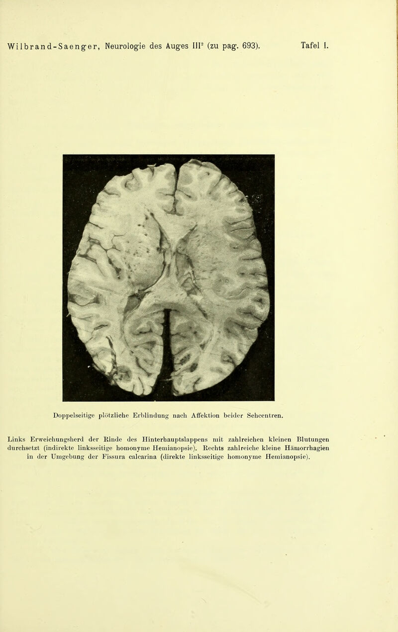 Links Erweichungsherd der Kinde des Hinterhauptslappens mit zahlreichen kleinen Blutungen durchsetzt (indirekte linksseitige homonyme Hemianopsie). Rechts zahlreiche kleine Hämorrhagien in der Umgebung der Fissura calcarina (direkte linksseitige homonyme Hemianopsie).