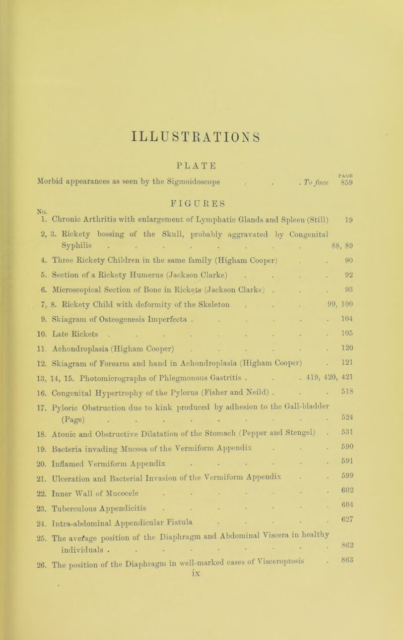 ILLUSTRATIONS PLATE vA(ir. Morbid appearances as seen by the Sigmoidoscope . . To face S59 FIGURES No. 1. Chronic Arthritis with enlargement of Lymphatic Glands and Spleen (Still) 19 2, 3. Rickety bossing of the Skull, probably aggravated by Congenital Syjihilis . . . . . . . . SS, 89 4. Three Rickety Children in the same lamily (Higham Cooper) . . 90 5. Section of a Rickety Humerus (Jackson Clarke) . . . .92 6. Microscopical Section of Bone in Rickets (Jackson Clarke) . . .93 7. 8. Rickety Child with deformity of the Skeleton . . 99, 100 9. Skiagram of Osteogenesis Imperfecta ...... 104 10. Late Rickets . . . . . .10.^) 11. Achondroplasia (Higliam Cooper) ...... 120 12. Skiagram of Forearm and hand in Achondroplasia (Iligham Cooper) . 121 13. 14, 15. Photomicrographs of Phlegmonous Gastritis . . . 419, 420, 421 16. Congenital Hypertrophy of the Pylorus (Fisher and Neild) . . . 518 17. Pyloric Obstruction due to kink produced by adhesion to the Gall-bladder (Page) 18. Atonic and Obstructive Dilatation of the Stoniacli fPepper and Stengel) . 531 19. Bacteria invading Mucosa of the Vermiform Ai)peiidi.\ . • 990 20. Inflamed Vermiform Appendix ...••• 991 21. Ulceration and Bacterial Invasion ol tlie Vermiform Appendix . . !>99 22. Inner Wall of iMucocele ...■•■• 902 23. Tuberculous Appendicitis 901 24. Intra-abdominal Ajipendicular Fistula . . ■ • • 9_/ 25. The avefage position of the Dia[ihragm and Abdominal Viscera in healthy 862 individuals 26. The position of the Diaphragm in well-marked cases of Visceroptosis . 863 l.N