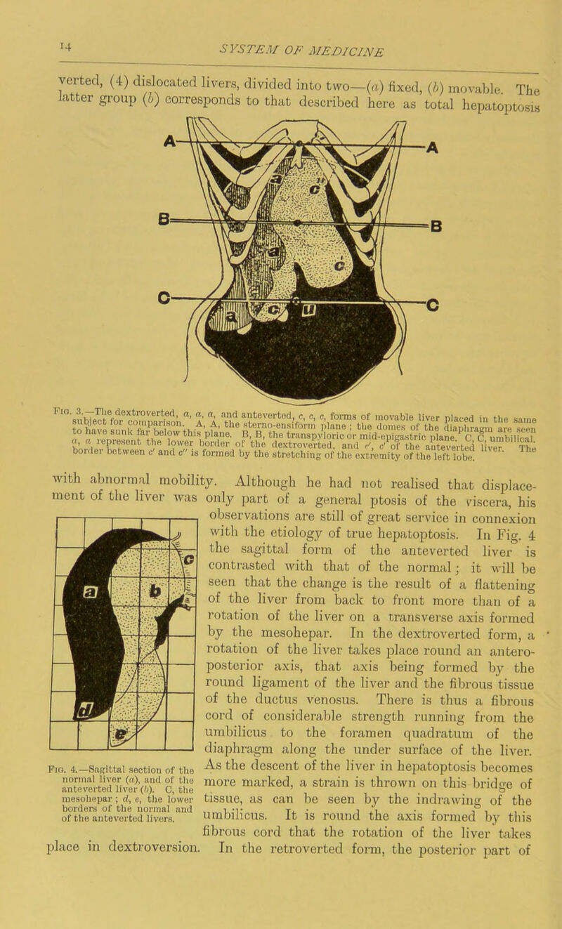 verted, (4) dislocated livers, divided into two—(a) fixed, (b) movable The latter group (b) corresponds to that described here as total hepatoptosis 1 on d’ ?• al alJd anteverted, c, c, c, forms of movable liver placed in the same to have am, Vi -A’ f’ the sterno-ensiform plane; the domes of the diaphragm are seen „° „ libe ?w * “s, P1®6’ B> B>the transpyloric or mid-epigastric plane. C C umbilical ?w®1’ Sorrier of the dextroverted, and c\ c' ol' the anteverted liver The boidei between c and c is formed by the stretching of the extremity of the left lobe with abnormal mobility. Although he had not realised that displace- ment of the liver was only part of a general ptosis of the viscera, his observations are still of great service in connexion with the etiology of true hepatoptosis. In Fig. 4 the sagittal form of the anteverted liver is contrasted with that of the normal; it will be seen that the change is the result of a flattening of the liver from back to front more than of a rotation of the liver on a transverse axis formed by the mesohepar. In the dextroverted form, a rotation of the liver takes place round an antero- posterior axis, that axis being formed by the round ligament of the liver and the fibrous tissue of the ductus venosus. There is thus a fibrous cord of considerable strength running from the umbilicus to the foramen quadratum of the diaphragm along the under surface of the liver. As the descent of the liver in hepatoptosis becomes more marked, a strain is thrown on this bridge of tissue, as can be seen by the indrawing of the umbilicus. It is round the axis formed by this fibrous cord that the rotation of the liver takes place in dextroversion. In the retroverted form, the posterior part of Fig. 4.—Sagittal section of the normal liver (a), and of the anteverted liver (b). C, the mesohepar; cl, e, the lower borders of the normal and of the anteverted livers.