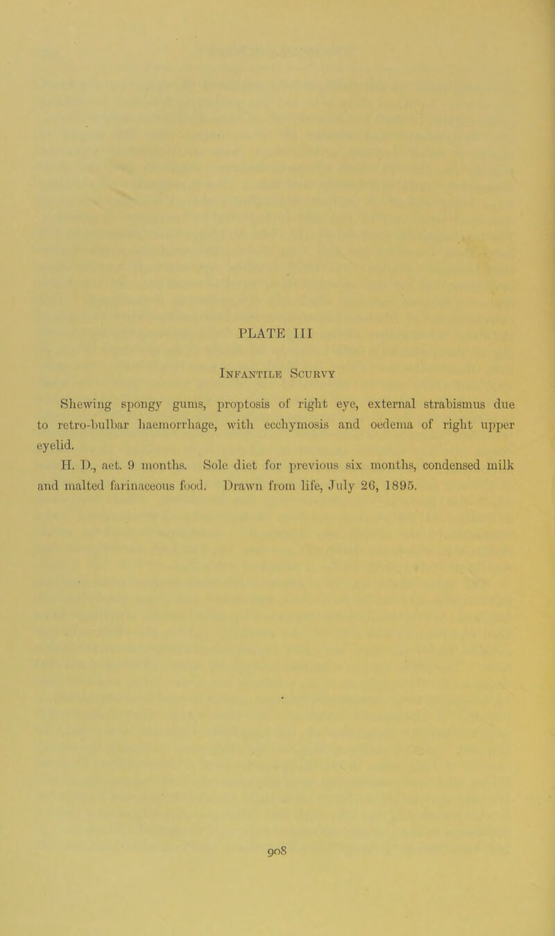 Infantile Scurvy Shewing spongy gums, pi’optosis of right eye, external strabismus due to retro-bulbar haemorrliage, with ecchymosis and oedema of right u^jper eyelid. II. 1)., act. 9 months. Sole diet for previous six months, condensed milk and malted faiinaceous food. Drawn from life, July 26, 1895. 90S