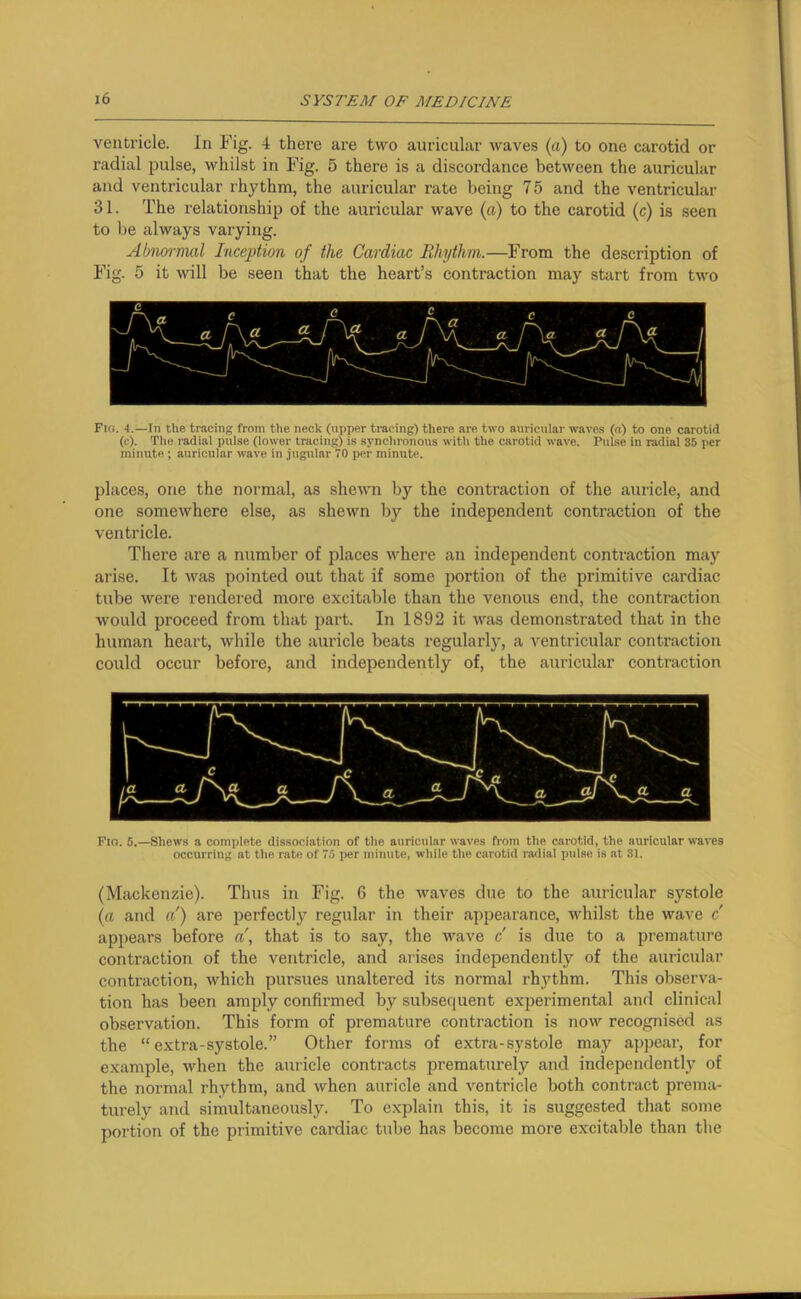 ventricle. In Fig. 4 there are two auricular waves (a) to one carotid or radial pulse, whilst in Fig. 5 there is a discordance between the auricular and ventricular rhythm, the auricular rate being 75 and the ventricular 31. The relationship of the auricular wave («) to the carotid (c) is seen to be always varying. Abnormal Inception of the Cardiac Rhythm.—From the description of Fig. 5 it will be seen that the heart’s contraction may start from two Fig. 4.—Tn the tracing from the neck (upper tracing) there are two auricular waves (a) to one carotid (c). The radial pulse (lower tracing) is synchronous with the carotid wave. Pulse in radial 35 per minute ; auricular wave in jugular 70 per minute. places, one the normal, as shewn by the contraction of the auricle, and one somewhere else, as shewn Ity the independent contraction of the ventricle. There are a number of places where an independent contraction may arise. It was pointed out that if some portion of the primitive cardiac tube were rendered more excitable than the venous end, the contraction would proceed from that part. In 1892 it was demonstrated that in the human heart, while the auricle beats regularly, a ventricular contraction could occur before, and independently of, the auricular contraction Fio. 5.—Shews a complete dissociation of the auricular waves from the carotid, the auricular waves occurring at the rate of 75 per minute, while the carotid radial pulse is at 31. (Mackenzie). Thus in Fig. 6 the waves due to the auricular systole (a and a ) are perfectly regular in their appearance, whilst the wave c appears before a', that is to say, the wave c' is due to a premature contraction of the ventricle, and arises independently of the auricular contraction, which pursues unaltered its normal rhythm. This observa- tion has been amply confirmed by subsequent experimental and clinical observation. This form of premature contraction is now recognised as the “extra-systole.” Other forms of extra-systole may appear, for example, when the auricle contracts prematurely and independently of the normal rhythm, and when auricle and ventricle both contract prema- turely and simultaneously. To explain this, it is suggested that some portion of the primitive cardiac tube has become more excitable than the