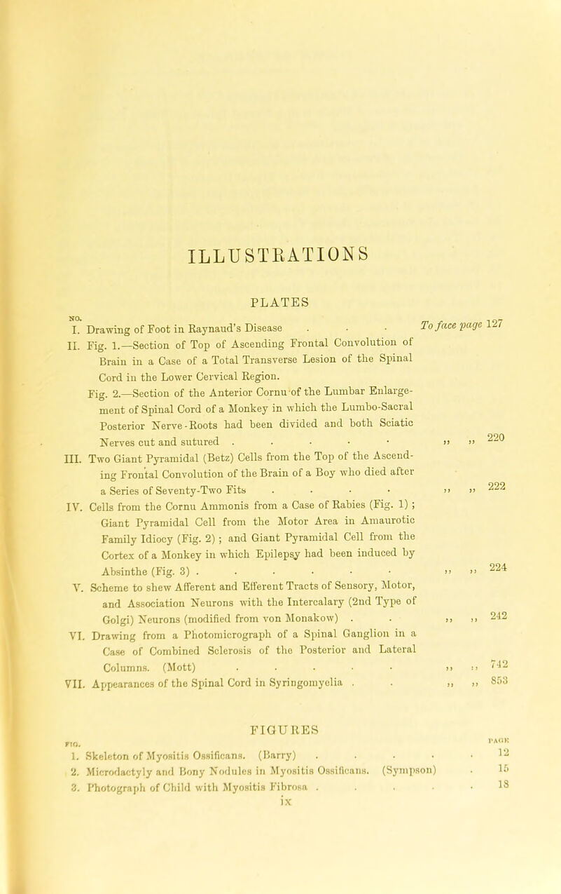 ILLUSTEATIONS PLATES I. Drawing of Foot in Eaynaud’s Disease . • • To face page lH II. Fig. 1.—Section of Top of Ascending Frontal Convolution of Brain in a Case of a Total Transverse Lesion of tlie Spinal Cord in the Lower Cervical Region. Fig. 2.—Section of the Anterior Cornu of the Lumbar Enlarge- ment of Spinal Cord of a Monkey in which the Lumbo-Sacral Posterior Nerve-Roots had been divided and both Sciatic Nerves cut and sutured . . ■ ■ • III. Two Giant Pyramidal (Betz) Cells from the Top of the Ascend- ing Frontal Convolution of the Brain of a Boy who died after a Series of Seventy-Two Fits .... IV. Cells from the Cornu Ammonis from a Case of Rabies (Fig. 1) ; Giant Pyramidal Cell from the Motor Area in Amaurotic Family Idiocy (Fig. 2) ; and Giant Pyramidal Cell from the Cortex of a Monkey in which Epilepsy had been induced by Absinthe (Fig. 3) . y. Scheme to shew Afferent and Efferent Tracts of Sensory, i\lotor, and Association Neurons with the Intercalary (2nd Type of Golgi) Neurons (modified from von Monakow) . VI. Drawing from a Photomicrograph of a Spinal Ganglion in a Ca.se of Combined Sclerosis of the Posterior and Lateral Columns. (Mott) ..... VII. Appearances of the Spinal Cord in Syringomyelia . 220 222 224 242 ) ) it „ 742 ,, S;>3 FIGURES in. 1. Skeleton of Myositis Ossificans. (Barry) . . . . 2. Microdactyly and Bony Nodules in Myositis Ossificans. (Sympson) 3. Photograph of Child with Myositis Fibrosa ....