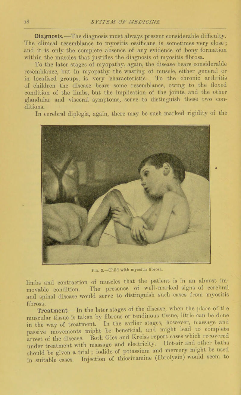 Diagnosis.—The diagnosis must always present considerable difficulty. The clinical resemblance to myositis ossificans is sometimes very close; and it is only the complete absence of any evidence of bony formation within the muscles that justifies the diagnosis of myositis fibrosa. To the later stages of myopathy, again, the disease bears considerable resemblance, but in myopathy the wasting of muscle, either general or in localised groups, is very characteristic. To the chronic arthritis of children the disease bears some resemblance, owing to the flexed condition of the limbs, but the implication of the joints, and the other glandular and visceral symptoms, serve to distinguish these two con- ditions. In cerebral diplegia, again, there may be such marked rigidity of the Fig. 3.—Child with myositis librosa. limbs and contraction of muscles that the patient is in an almost im- movable condition. The presence of well-marked signs of cerebral and spinal disease would serve to distinguish such cases fiom myositis fibrosa. Treatment.—In the later stages of the disease, when the ])lace of tl e muscular tissue is taken by fibrous or tendinous tissue, little can he done in the way of treatment. In the earlier stages, however, massage atnl passive movements might be beneficial, ami might lead to complete arrest of the disease. Both Gies and Kreiss report cases which recovered under treatment with massage and electricity, llot-.nr and other baths should be given a trial; iodide of potassium and mercniy might be used in suitable cases. Injection of thiosinamine (fibrolysni) would seem to