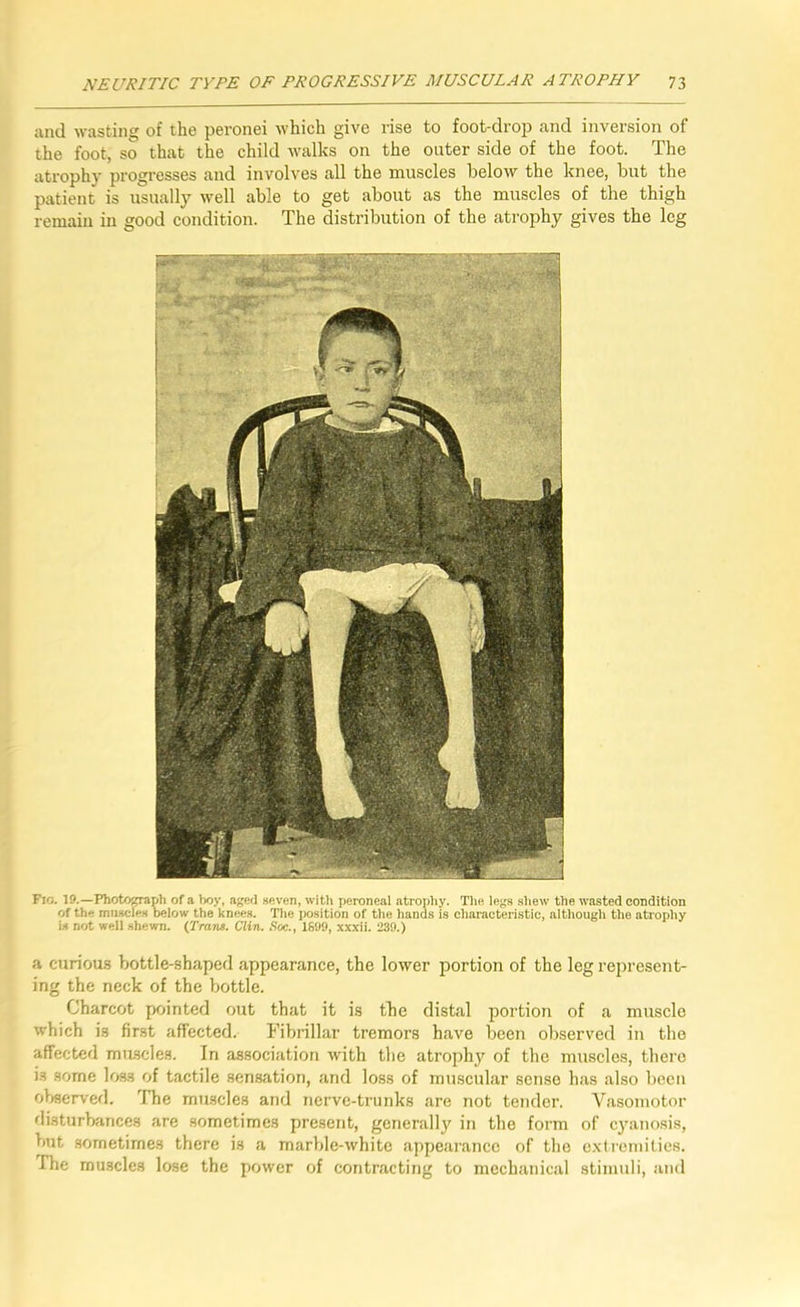 and wasting of the peronei which give rise to foot-drop and inversion of the foot, so that the child walks on the outer side of the foot. The atrophy progresses and involves all the muscles below the knee, but the patient is usually well able to get about as the muscles of the thigh remain in good condition. The distribution of the atrophy gives the leg Fio. 19.—Photograph of a boy, aged seven, witli peroneal atrophy. The legs shew the wasted condition of the muscles below the knees. The position of the hands is characteristic, although the atrophy is not well shewn. (Trans. Clin. Soc., 1699, xxxii. 239.) a curious bottle-shaped appearance, the lower portion of the leg represent- ing the neck of the bottle. Charcot pointed out that it is the distal portion of a muscle which is first affected. Fibrillar tremors have been observed in the affected mirscles. In association with the atrophy of the muscles, there is some loss of tactile sensation, and loss of muscular sense h.as also been observed. The muscles and nerve-trunks are not tender. Vasomotor disturbances are sometimes present, generally in the form of cjhanosis, but sometimes there is a marble-white appearance of the e.vlreniities. fhe muscles lose the power of contracting to mechanical stimuli, and