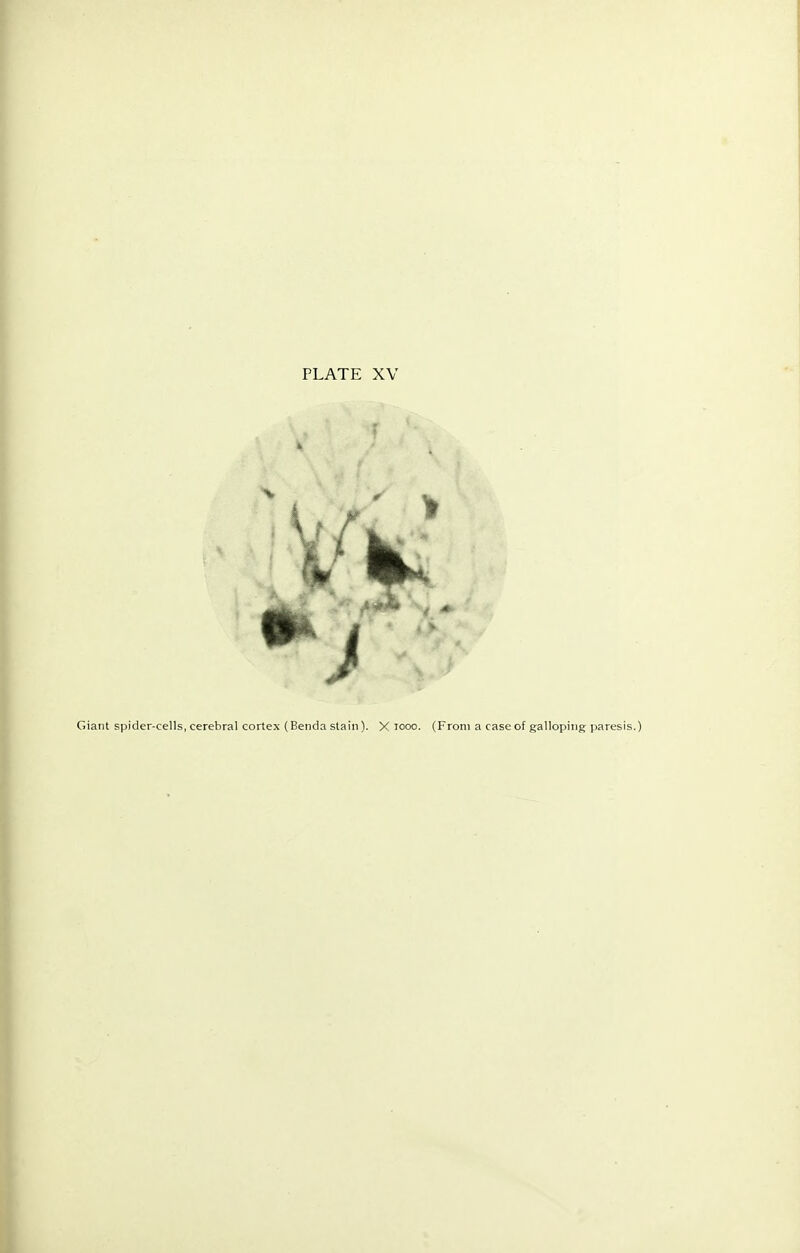 Giant spider-cells, cerebral cortex (Benda stain). X looo. (From a case of galloping paresis.)