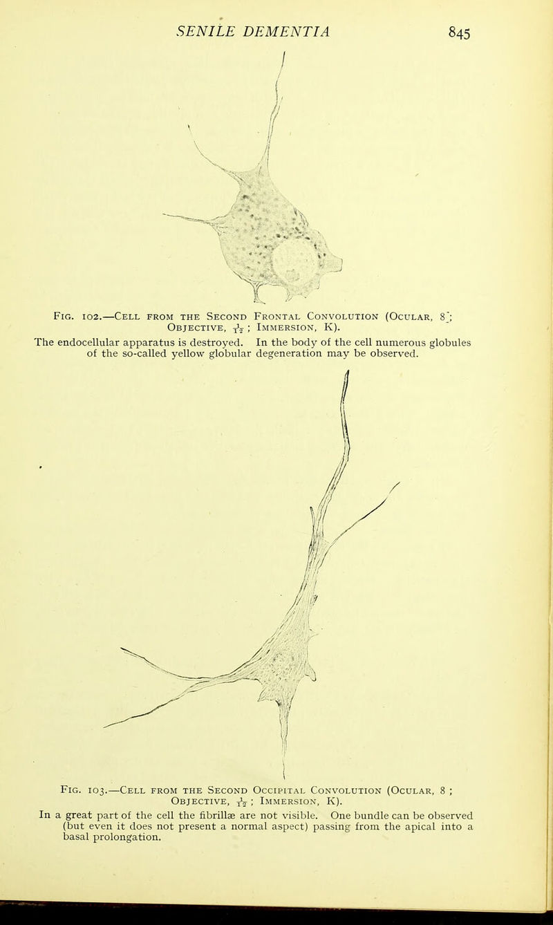 w ':.'J Fig. 102.—Cell from the Second Frontal Convolution (Ocular, 8; Objective, tV ; Immersion, K). The endocellular apparatus is destroyed. In the body of the cell numerous globules of the so-called yellow globular degeneration may be observed. Fig. 103. -Cell from the Second Occipital Convolution (Ocular, 8 ; Objective, ; Immersion, K). In a great part of the cell the fibrillse are not visible. One bundle can be observed (but even it does not present a normal aspect) passing from the apical into a basal prolongation.