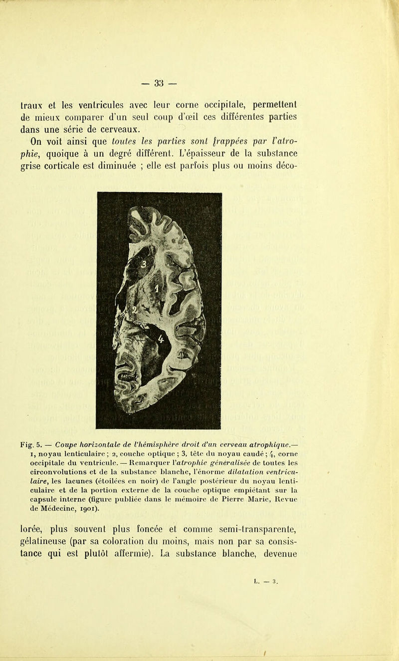 traux et les ventricules avec leur corne occipitale, permettent de mieux comparer d'un seul coup d'œil ces différentes parties dans une série de cerveaux. On voit ainsi que toutes les parties sont Irappées par Vatro- phie, quoique à un degré différent. L'épaisseur de la substance grise corticale est diminuée ; elle est parfois plus ou moins déco- Fig. 5. — Coupe horizontale de l'hémisphère droit d'un cerveau atrophique.— I, noyau lenticulaire ; 2, couche optique ; 3, tète du noyau caudé ; 4, corne occipitale du ventricule. — Remarquer Vatrophie généralisée de toutes les circonvolutions et de la substance blanche, l'énorme dilatation ventricu- laire, les lacunes (étoilées en noir) de l'angle postérieur du noyau lenti- culaire et de la portion externe de la couche optique empiétant sur la capsule interne (figure publiée dans le mémoire de Pierre Marie, Revue de Médecine, 1901). lorée, plus souvent plus foncée et comme semi-transparente, gélatineuse (par sa coloration du moins, mais non par sa consis- tance qui est plutôt affermie). La substance blanche, devenue h. — 3.