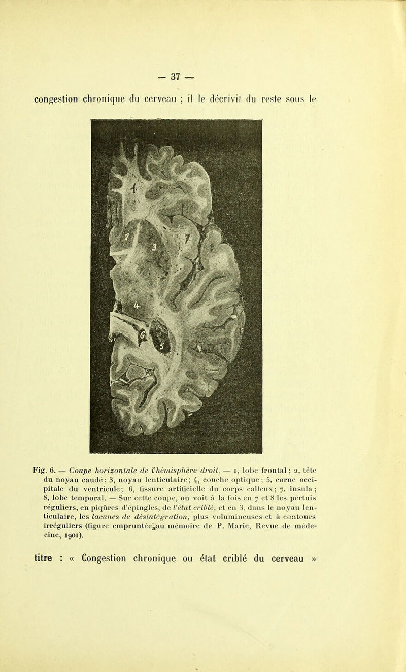 congestion chronique du cerveau ; il le décrivil du reste sous le Fig. 6. — Coupe horizontale de l'hémisphère droit. — i, lobe frontal ; 2, tête du noyau caudé ; 3, noyau lenticulaire; /J, couche optique; 5, corne occi- pitale du ventricule; 6, tissure artificielle du corps calleux; 7, insula ; 8, lobe temporal. — Sur cette coupe, on voit à la fois en 7 et 8 les pertuis réguliers, en piqiires d'épingles, de l'état criblé, et en 3, dans le noyau len- ticulaire, les lacunes de désintégration, plus volumineuses et à contours irréguliers (figure empruntée^^au mémoire de P. Marie, Revue de méde- cine, 1901). titre : « Congestion chronique ou état criblé du cerveau »
