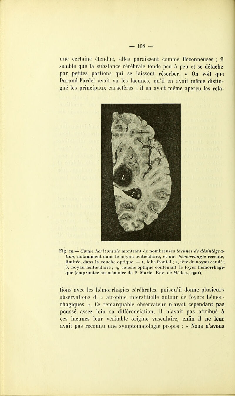 line certaine étendue, elles paraissent comme Floconneuses ; il semble que la substance cérébrale fonde peu à peu et se détache par petites portions qui se laissent résorber. « On voit que Durand-Fardel avait vu les lacunes, qu'il en avait même distin- gué les principaux caractères ; il en avait même aperçu les rela- Fig. 19.— Coupe horizontale montrant de nombreuses lacunes de désintégra- tion, notamment dans le noyau lenticulaire, et une hémorrhagie récente, limitée, dans la couche optique. — i, lobe frontal ; 2, tète du noyau caudé; 3, noyau lenticulaire ; 4i couche optique contenant le foyer hémorrhagi- que (empruntée au mémoire de P. Marie, Rev. de Médec., 1901). tions avec les hémorrhagies cérébrales, puisqu'il donne plusieurs observations d' <( airophie inlerstilielle autour de foyers hémor- rhagiques ». Ce remarquable observateur n'avait cependant pas poussé assez loin sa différenciation, il n'avait pas attribue à ces lacunes leur véritable origine vasculaire, enfin il ne leur avait pas reconnu une symptomatologie propre : « Nous n'avons