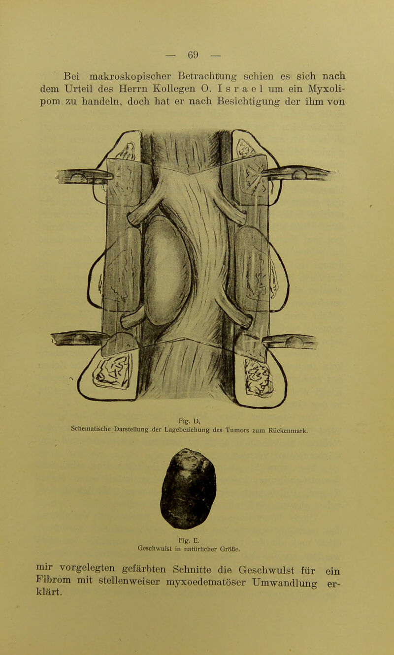 Bei makroskopischer Betrachijung schien es sich nach dem Urteil des Herrn Kollegen 0. Israel um ein Myxoli- pom zu handeln, doch hat er nach Besichtigung der ihm von Fig. D. Schematische Darstellung der Lagebeziehung des Tumors zum Rückenmark. Fig. E. Geschwulst in natürlicher Größe. mir vorgelegten gefärbten Schnitte die Geschwulst für ein Fibrom mit stellenweiser myxoedematöser Umwandlung er- klärt.