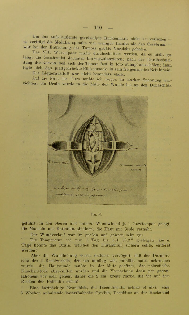 Um das aufs äußerste gcsclmdigte Rückenmark nicht zu verletzen es verträgt die MeduUa epinalis viel weniger Insulte als das Cerebrum - war bei der Entfernung des Tumors größte Vorsicht geboten. Das VII. Wurzelpaar mußte durchschnitten werden, da es nicht ge- lang, die Geschwulst darunter hinwegzuianzieren; nach der Durchschnei- dung der Nerven ließ sich der Tumor fast in toto stumpf ausschälen; dann legte sich das plattgedrückte Rückenmark in sein freigemachtes Bett hinein. Der Liquorausfluß war nicht besonders stark. Auf die Naht der Dura mußte- ich wegen zu starker Spannung ver- zichten; ein Drain wurde iTi die Milte der Wunde bis an den Duraschlitz Fig. N. geführt, in den oberen und unteren Wundwinkel je 1 Gazetampon gelegt, die Muskeln mit Katgutknopfnählen, die Haut mit Seide vernäht. Der Wundverlauf war im großen und ganzen sebr gut. Die Temperatur ist nur 1 Tag bis auf 38.2 gestiegen; am 4. Tage konnte das Drain, welches den Duraabfluß sichern sollte, entfernt werden! Aber die Wundheilung wurde dadurch verzögert, daß der Dornfort- satz des I. Brustwirbels, den ich unnötig weit entblößt hatte, nekrotisch wurde; die Hautwunde mußte in der Mitte geöffnet, das nekrotische Knochenstück abgekniffen werden und die Vernarbung dann per granu- lationem vor sich gehen; daher die 2 cm breite Narbe, die Sie auf dem Rücken der Patientin sehen! Eine hartnäckige Bronchitis, die Incontinentia urinae et alvi, eine 3 Wochen anhaltende katarrhalische Cystitis, Decubitus an der Hacke und