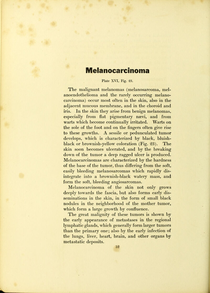 Melanocarcinoma Plate XVI, Fig. 23. The malignant melanomas (melanosarcoma, mel- anoendothelioma and the rarely occurring melano- carcinoma) occur most often in the skin, also in the adjacent mucous membrane, and in the choroid and iris. In the skin they arise from benign melanomas, especially from flat pigmentary nsevi, and from warts which become continually irritated. Warts on the sole of the foot and on the fingers often give rise to these growths. A sessile or pedunculated tumor develops, which is characterized by black, bluish- black or brownish-yellow coloration (Fig. 23). The skin soon becomes ulcerated, and by the breaking down of the tumor a deep ragged ulcer is produced. Melanocarcinomas are characterized by the hardness of the base of the tumor, thus differing from the soft, easily bleeding melanosarcomas which rapidly dis- integrate into a brownish-black watery mass, and form the soft, bleeding angiosarcomas. Melanocarcinoma of the skin not only grows deeply towards the fascia, but also forms early dis- seminations in the skin, in the form of small black nodules in the neighborhood of the mother tumor, which form a large growth by confluence. The great malignity of these tumors is shown by the early appearance of metastases in the regional lymphatic glands, which generally form larger tumors than the primary one; also by the early infection of the lungs, liver, heart, brain, and other organs by metastatic deposits.