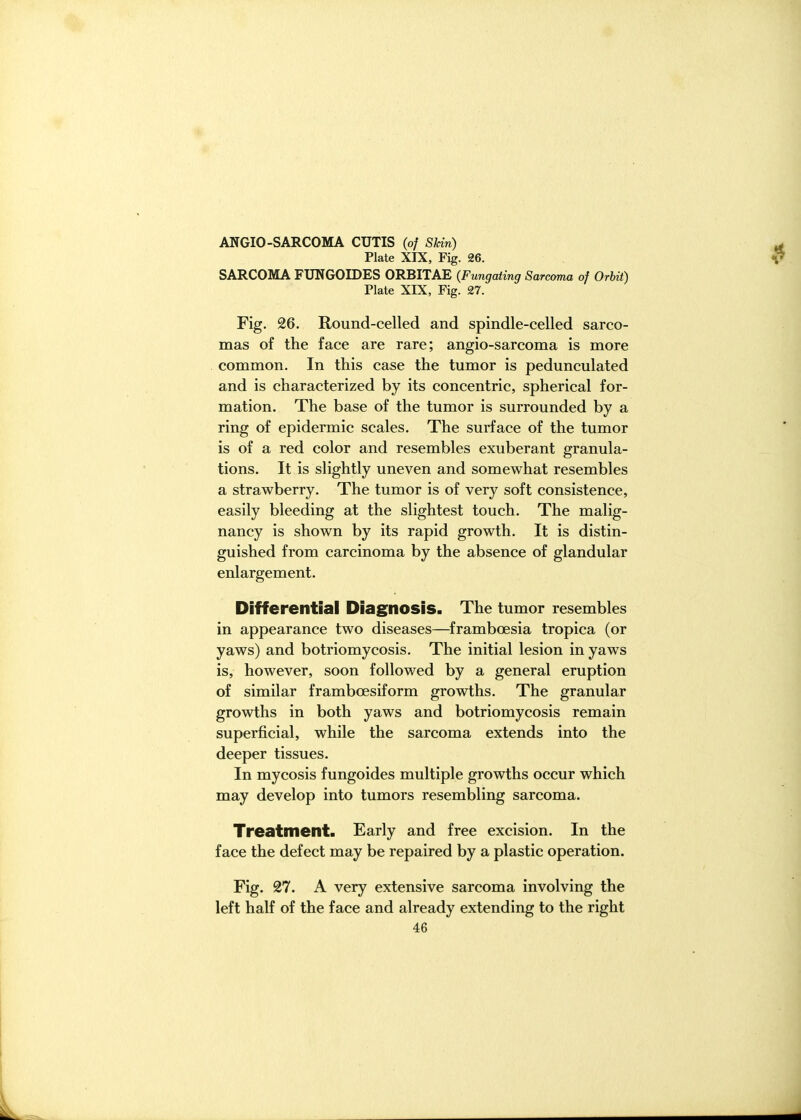ANGIO-SARCOMA CUTIS (of Skin) Plate XIX, Fig. 26. SARCOMA FUNGOIDES ORBITAE (Fungating Sarcoma of OrUt) Plate XIX, Fig. 27. Fig. 26. Round-celled and spindle-celled sarco- mas of the face are rare; angio-sarcoma is more common. In this case the tumor is pedunculated and is characterized by its concentric, spherical for- mation. The base of the tumor is surrounded by a ring of epidermic scales. The surface of the tumor is of a red color and resembles exuberant granula- tions. It is slightly uneven and somewhat resembles a strawberry. The tumor is of very soft consistence, easily bleeding at the slightest touch. The malig- nancy is shown by its rapid growth. It is distin- guished from carcinoma by the absence of glandular enlargement. Differential Diagnosis. The tumor resembles in appearance two diseases—^framboesia tropica (or yaws) and botriomycosis. The initial lesion in yaws is, however, soon followed by a general eruption of similar framboesiform growths. The granular growths in both yaws and botriomycosis remain superficial, while the sarcoma extends into the deeper tissues. In mycosis fungoides multiple growths occur which may develop into tumors resembling sarcoma. Treatment. Early and free excision. In the face the defect may be repaired by a plastic operation. Fig. 27. A very extensive sarcoma involving the left half of the face and already extending to the right