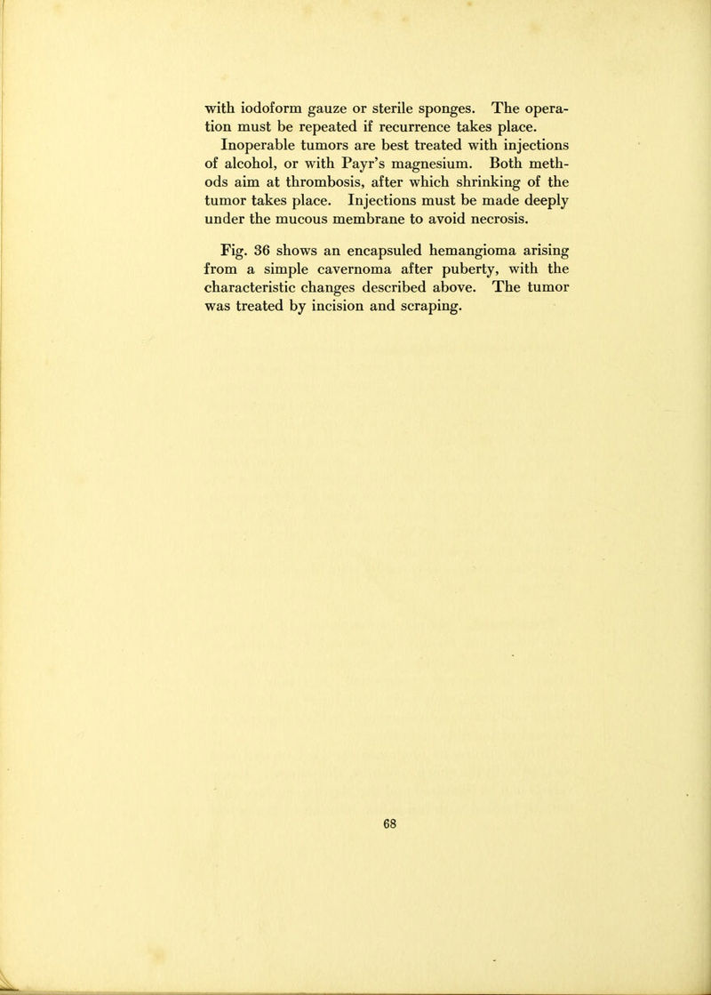 with iodoform gauze or sterile sponges. The opera- tion must be repeated if recurrence takes place. Inoperable tumors are best treated with injections of alcohol, or with Payr's magnesium. Both meth- ods aim at thrombosis, after which shrinking of the tumor takes place. Injections must be made deeply under the mucous membrane to avoid necrosis. Fig. 36 shows an encapsuled hemangioma arising from a simple cavernoma after puberty, with the characteristic changes described above. The tumor was treated by incision and scraping.