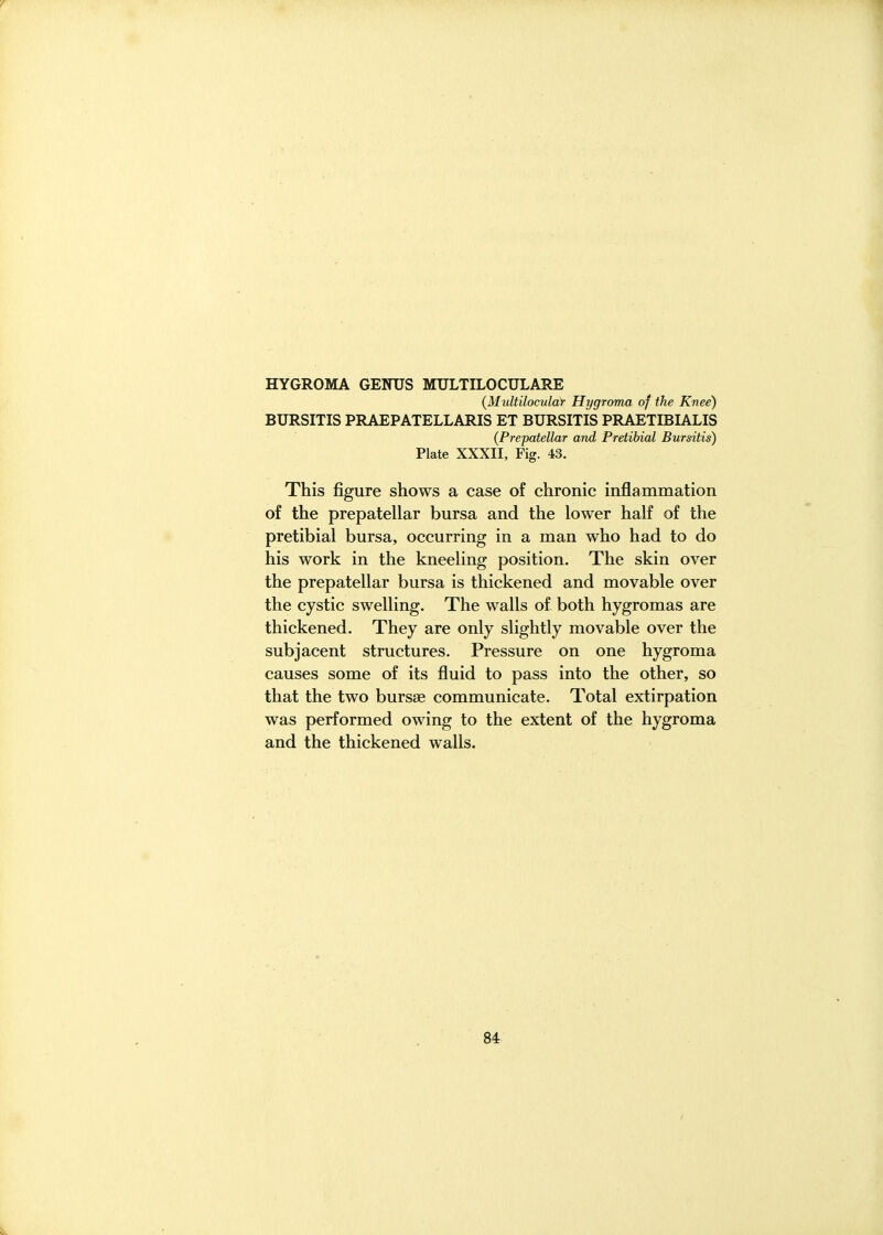 HYGROMA GENUS MTJLTILOCULARE {Multilocular Hygroma of the Knee) BURSITIS PRAEPATELLARIS ET BURSITIS PRAETIBIALIS {Prepatellar and Pretibial Bursitis) Plate XXXII, Fig. 43. This figure shows a case of chronic inflammation of the prepatellar bursa and the lower half of the pretibial bursa, occurring in a man who had to do his work in the kneeling position. The skin over the prepatellar bursa is thickened and movable over the cystic swelling. The walls of both hygromas are thickened. They are only slightly movable over the subjacent structures. Pressure on one hygroma causes some of its fluid to pass into the other, so that the two bursse communicate. Total extirpation was performed owing to the extent of the hygroma and the thickened walls.