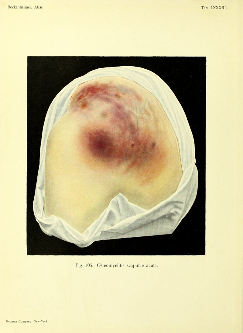 Fig. 105. Osteomyelitis scapulae acuta.