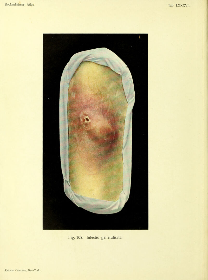 Bockenheimer, Atlas. Tab. LXXXVI. Fig. 108. Infectio generalisata. Rebinan Coiii|)any, Nevi-York.