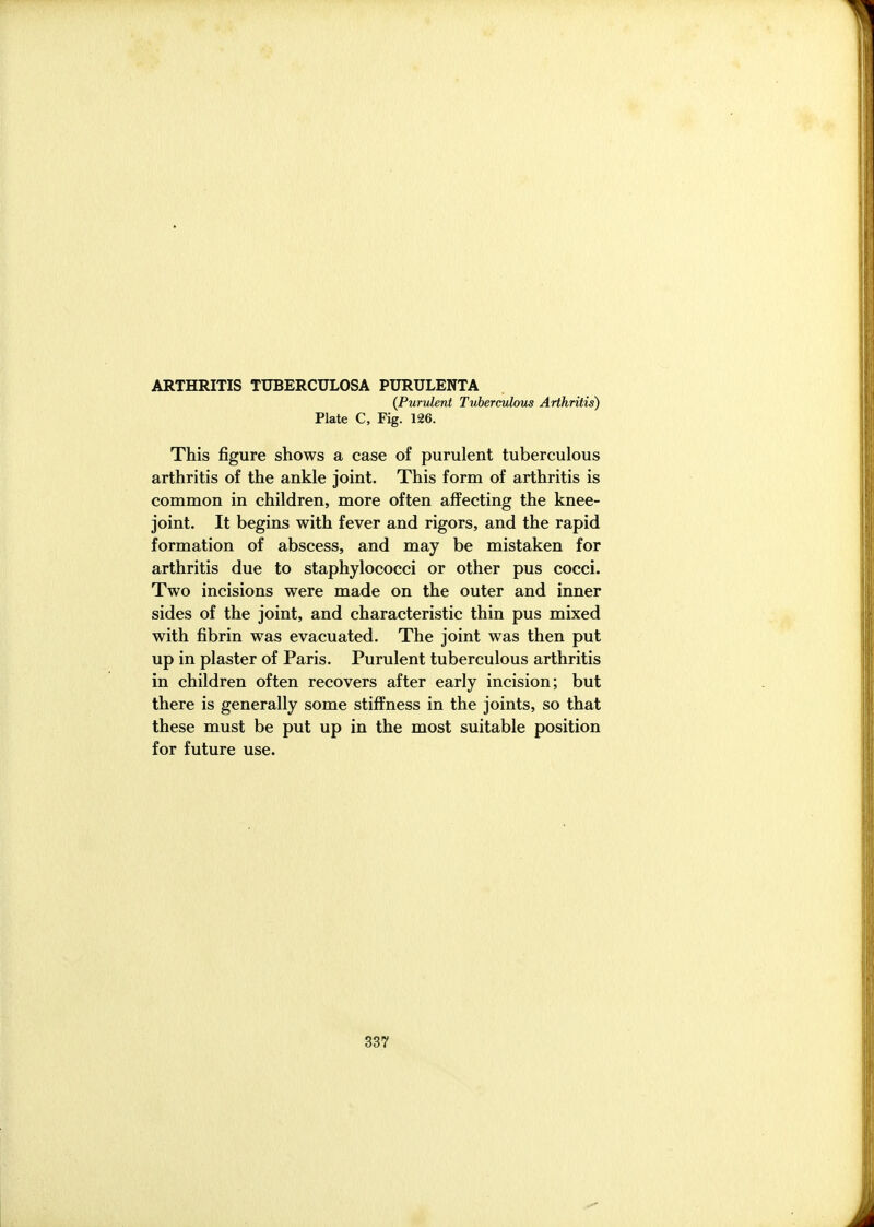 ARTHRITIS TUBERCULOSA PURULENTA {Purulent Tuberculous Arthritis) Plate C, Fig. 126. This figure shows a case of purulent tuberculous arthritis of the ankle joint. This form of arthritis is common in children, more often affecting the knee- joint. It begins with fever and rigors, and the rapid formation of abscess, and may be mistaken for arthritis due to staphylococci or other pus cocci. Two incisions were made on the outer and inner sides of the joint, and characteristic thin pus mixed with fibrin was evacuated. The joint was then put up in plaster of Paris. Purulent tuberculous arthritis in children often recovers after early incision; but there is generally some stiffness in the joints, so that these must be put up in the most suitable position for future use.