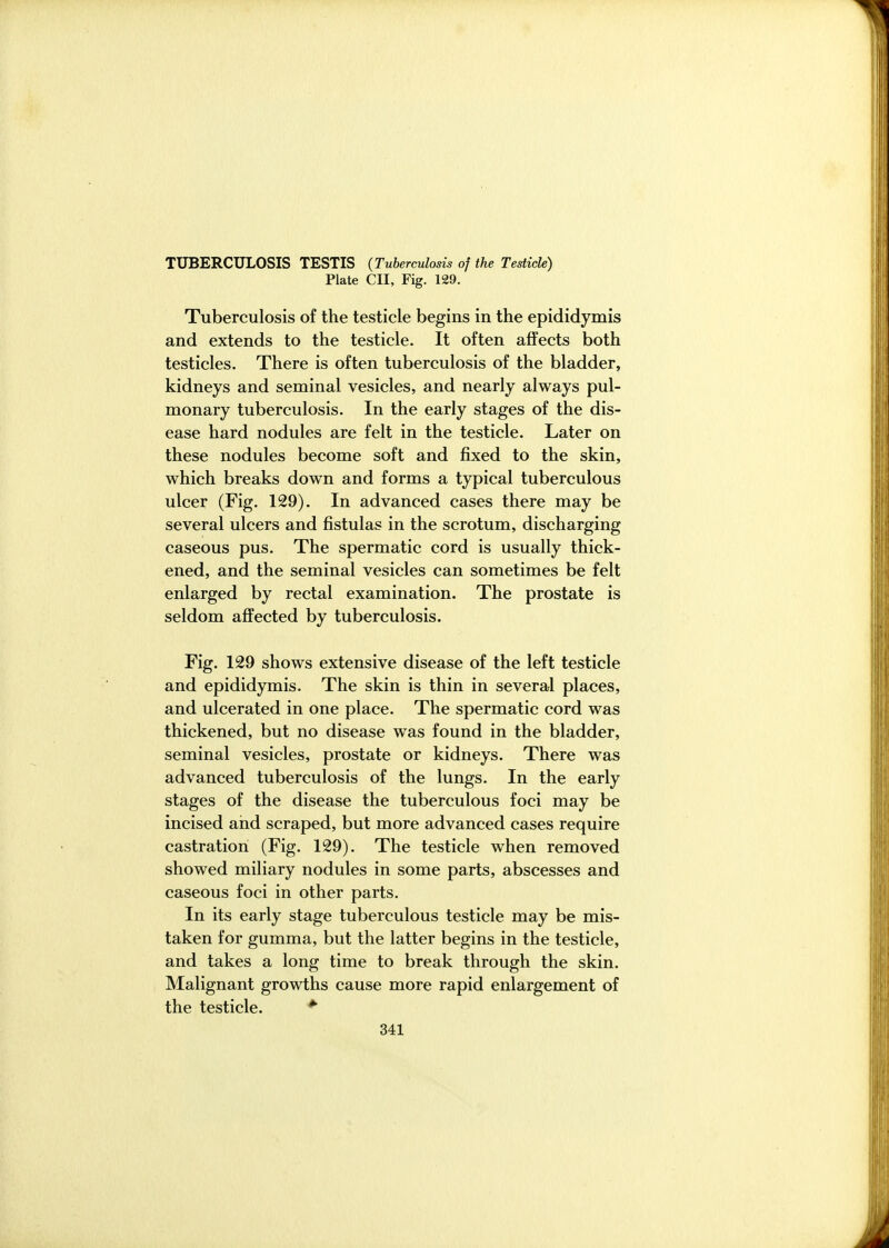 TUBERCULOSIS TESTIS (Tuberculosis of the Testicle) Plate CII, Fig. 129. Tuberculosis of the testicle begins in the epididymis and extends to the testicle. It often affects both testicles. There is often tuberculosis of the bladder, kidneys and seminal vesicles, and nearly always pul- monary tuberculosis. In the early stages of the dis- ease hard nodules are felt in the testicle. Later on these nodules become soft and fixed to the skin, which breaks down and forms a typical tuberculous ulcer (Fig. 129). In advanced cases there may be several ulcers and fistulas in the scrotum, discharging caseous pus. The spermatic cord is usually thick- ened, and the seminal vesicles can sometimes be felt enlarged by rectal examination. The prostate is seldom affected by tuberculosis. Fig. 129 shows extensive disease of the left testicle and epididymis. The skin is thin in several places, and ulcerated in one place. The spermatic cord was thickened, but no disease was found in the bladder, seminal vesicles, prostate or kidneys. There was advanced tuberculosis of the lungs. In the early stages of the disease the tuberculous foci may be incised and scraped, but more advanced cases require castration (Fig. 129). The testicle when removed showed miliary nodules in some parts, abscesses and caseous foci in other parts. In its early stage tuberculous testicle may be mis- taken for gumma, but the latter begins in the testicle, and takes a long time to break through the skin. Malignant growths cause more rapid enlargement of the testicle.