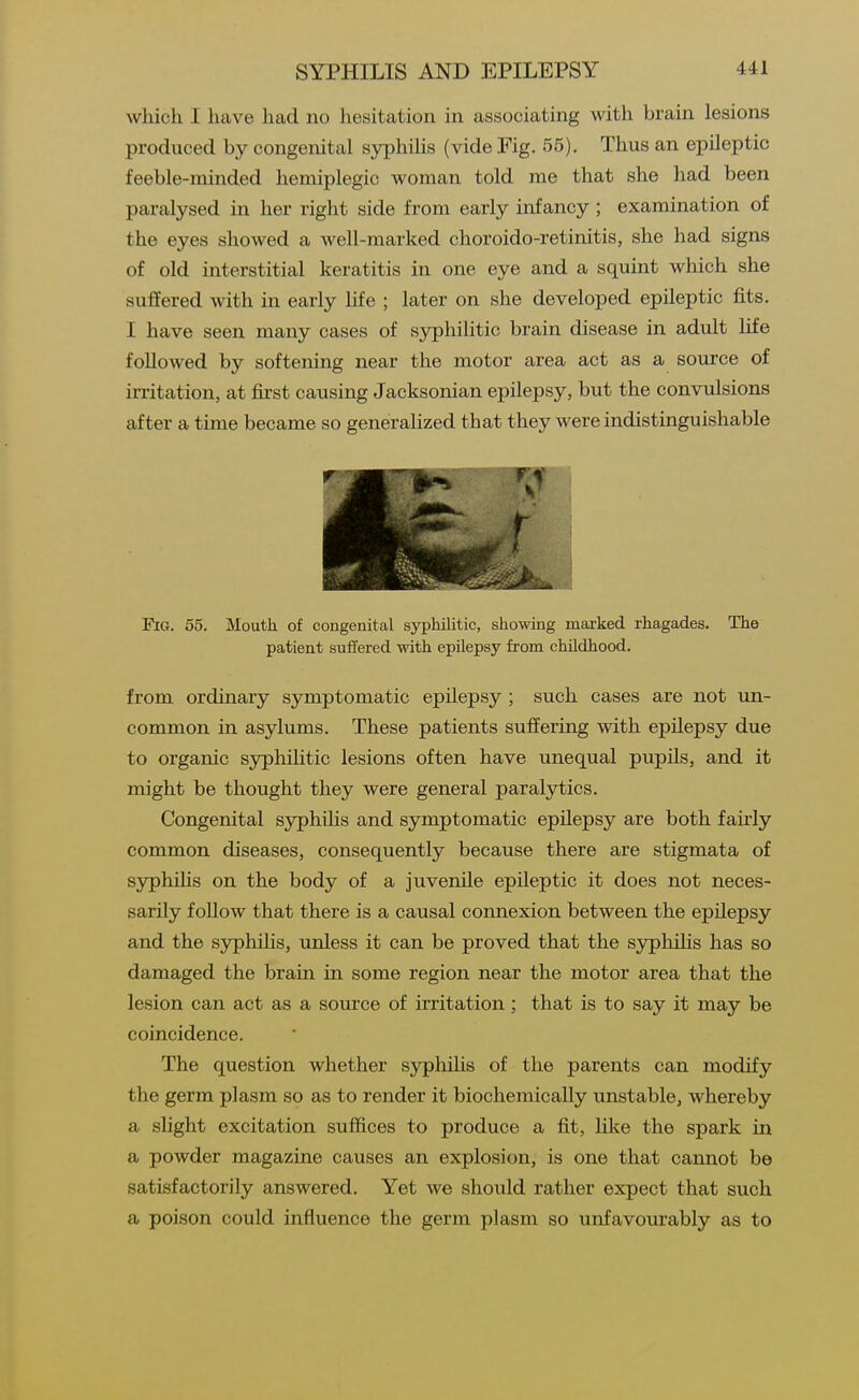 wliich I have had no hesitation in associating with brain lesions produced by congenital syphilis (vide Fig. 55). Thus an epileptic feeble-minded hemiplegic woman told me that she had been paralysed in her right side from early infancy; examination of the eyes showed a well-marked choroido-retinitis, she had signs of old interstitial keratitis in one eye and a squint which she suffered with in early Ufe ; later on she developed epileptic fits. I have seen many cases of sjrphilitic brain disease in adult life followed by softening near the motor area act as a source of irritation, at first causing Jacksonian epilepsy, but the convulsions after a time became so generalized that they were indistinguishable Fig. 55. Mouth of congenital sypMlitic, showing marked rhagades. The patient suffered mth epilepsy from childhood. from ordinary symptomatic epilepsy ; such cases are not un- common in asylums. These patients suffering with epilepsy due to organic syphilitic lesions often have unequal pupils, and it might be thought they were general paralytics. Congenital syphiHs and symptomatic epilepsy are both fairly common diseases, consequently because there are stigmata of syphihs on the body of a juvenile epileptic it does not neces- sarily follow that there is a causal connexion between the epilepsy and the syphilis, unless it can be proved that the S3rpliLlis has so damaged the brain in some region near the motor area that the lesion can act as a source of irritation; that is to say it may be coincidence. The question whether syphihs of the parents can modify the germ plasm so as to render it biochemically unstable, whereby a slight excitation suffices to produce a fit, like the spark in a powder magazine causes an explosion, is one that cannot be satisfactorily answered. Yet we should rather expect that such a poison could influence the germ plasm so unfavourably as to