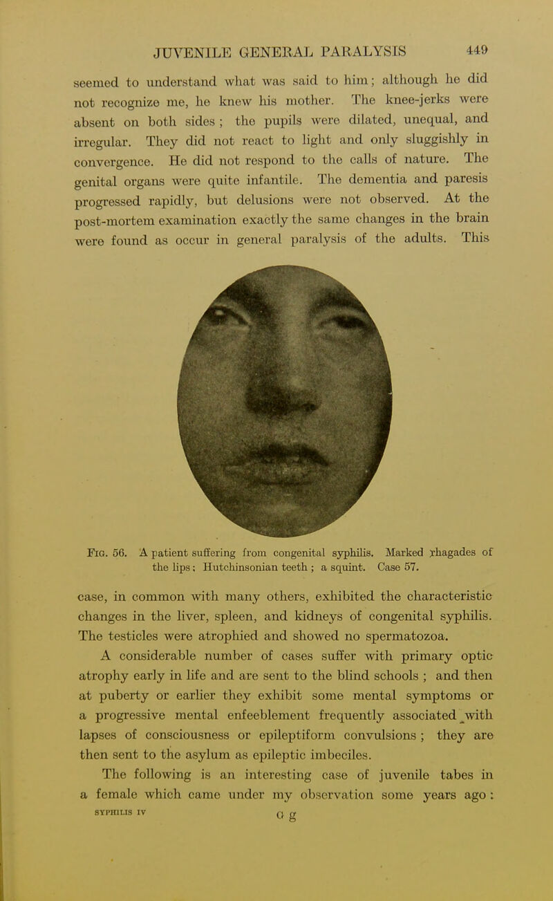seemed to understand what Avas said to liini; although he did not recognize me, he knew his mother. The knee-jerks were absent on both sides ; the pupils were dilated, unequal, and irregular. They did not react to light and only sluggishly in convergence. He did not respond to the calls of nature. The genital organs were quite infantile. The dementia and paresis progressed rapidly, but delusions were not observed. At the post-mortem examination exactly the same changes in the brain were found as occur in general paralysis of the adults. This Fio. 56. A patient suffering from congenital syphilis. Marked xliagades of the lips; Hutchinsonian teeth ; a squint. Case 57. case, in common with many others, exhibited the characteristic changes in the liver, spleen, and kidneys of congenital syphilis. The testicles were atrophied and showed no spermatozoa. A considerable number of cases suffer with primary optic atrophy early in life and are sent to the blind schools ; and then at puberty or earlier they exhibit some mental symptoms or a progressive mental enfeeblement frequently associated ^with lapses of consciousness or epileptiform convulsions ; they are then sent to the asylum as epileptic imbeciles. The following is an interesting case of juvenile tabes in a female which came under ray observation some years ago : SYPHILIS IV r\ (f