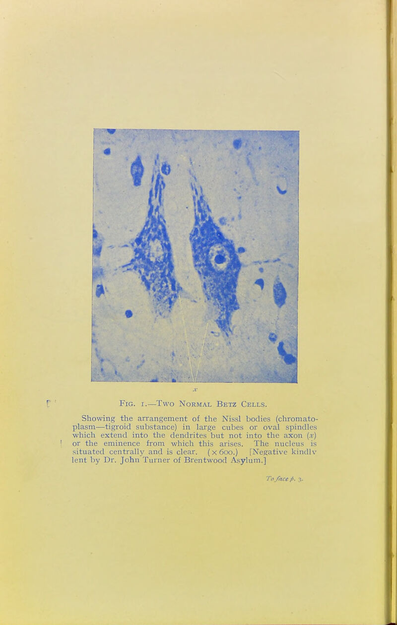 r ' Fig. r.—Two Normal Betz Cells. Showing the arrangement of the Nissl bodies (cliromato- plasm—tigroid substance) in large cubes or oval spindles which extend into the dendrites but not into the axon (x) ' or the eminence from which this arises. The nucleus is situated centrally and is clear. { x 600.) [Negative kindlv lent by Dr. John Turner of Brentwood Asylum.] To/ace fi. 3.