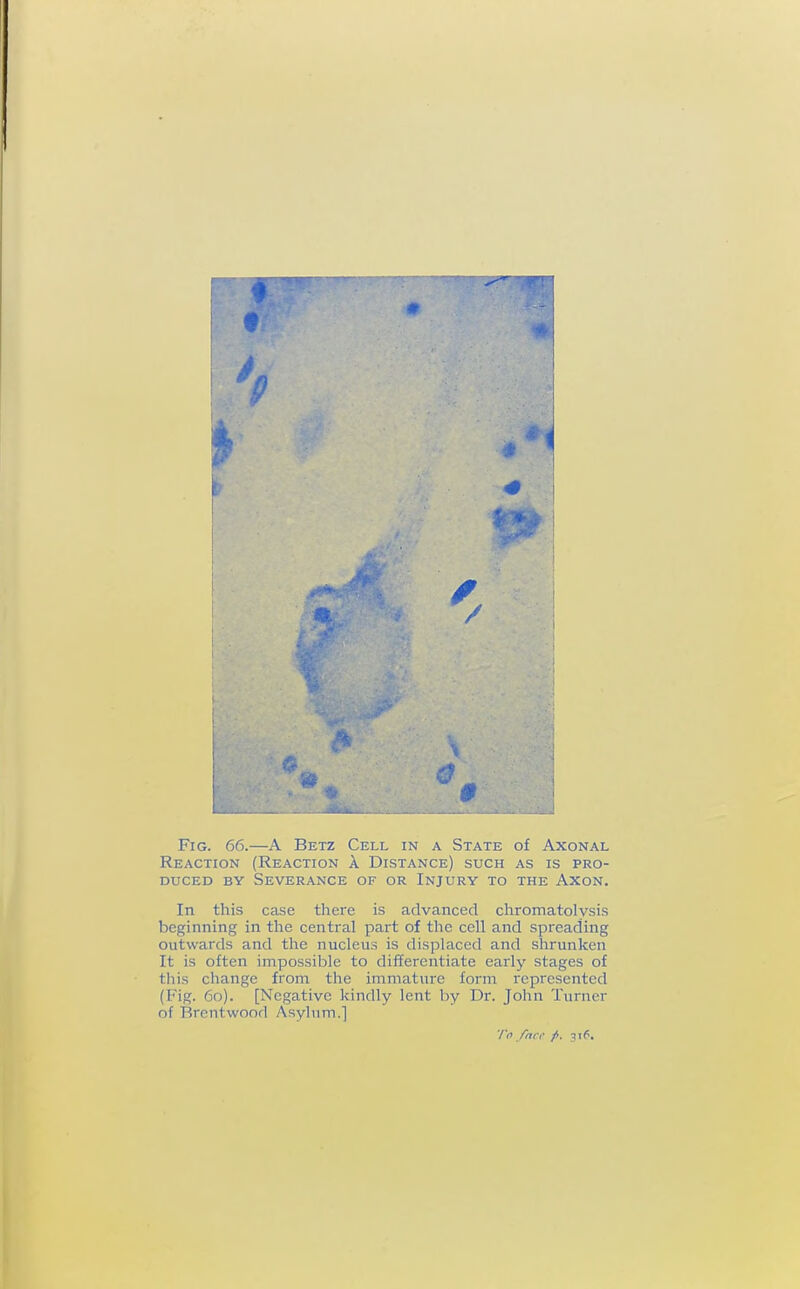 Fig. 66.—A Betz Cell in a State of Axonal Reaction (Reaction A Distance) such as is pro- duced BY Severance of or Injury to the Axon. In this case there is advanced chromatolysis beginning in the central part of the cell and spreading outwards and the nucleus is displaced and shrunken It is often impossible to differentiate early stages of this change from the immature form represented (Fig. 60). [Negative kindly lent by Dr. John Turner of Brentwood Asylum.] */V> fnct' p, 316,