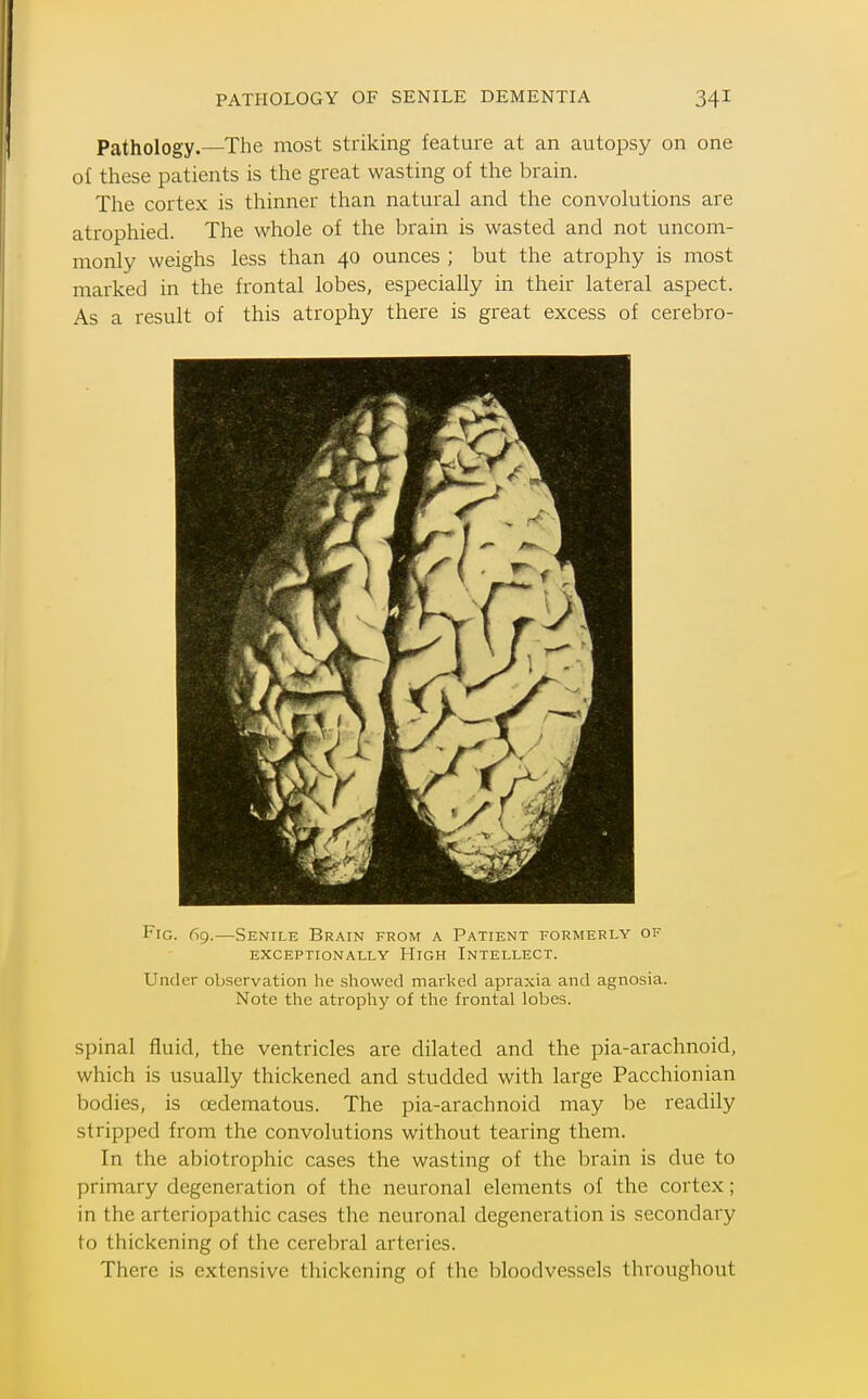 PATHOLOGY OF SENILE DEMENTIA Pathology.—The most striking feature at an autopsy on one of these patients is the great wasting of the brain. The cortex is thinner than natural and the convolutions are atrophied. The whole of the brain is wasted and not uncom- monly weighs less than 40 ounces ; but the atrophy is most marked in the frontal lobes, especially in their lateral aspect. As a result of this atrophy there is great excess of cerebro- FiG. 69.—Senile Brain from a Patient formerly of EXCEPTIONALLY HiGH INTELLECT. Under observation he showed marked apraxia and agnosia. Note the atrophy of the frontal lobes. spinal fluid, the ventricles are dilated and the pia-arachnoid, which is usually thickened and studded with large Pacchionian bodies, is oedematous. The pia-arachnoid may be readily stripped from the convolutions without tearing them. In the abiotrophic cases the wasting of the brain is due to primary degeneration of the neuronal elements of the cortex; in the arteriopathic cases the neuronal degeneration is secondary to thickening of the cerebral arteries. There is extensive thickening of the bloodvessels throughout