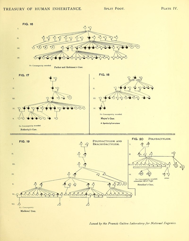 FIG. 16 HI. IV. Parker and Robinson's Case, FIG. 17 No Consanguinity, recorded. Fotherby's Case. FIG. 18 ^st 2nd V No Consanguinity recorded. Mayer's Case. Syndactylism alone FIG. 19 polydactylism and ^ Brachydactylism. 11. ( IV. FIG. 20 POLYDACTYLlSM. in.,5 .63646 59 69 iQ iQjj No Consanguinity recorded. aa/ia Struther's Case, VII ,5 No Consanguinity. Mathews' Case