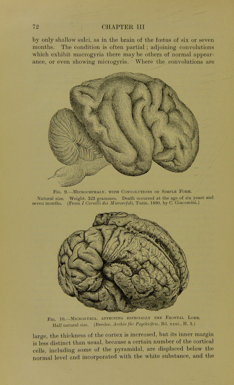 by only shallow sulci, as in the brain of the foetus of six or seven months. The condition is often partial; adjoining convolutions which exliibit macrogyria there may be others of normal appear- ance, or even showing microgyria. Where the convolutions are Fig. 9.—^Mickocephaly, with Convolutions oi- Simple Fobm. Natural size. Weight, 323 grammes. Death occurred at the age of six years and seven months. (From / Cervelli dei Microcefali, Turin, 1890, by C. Giacomini.) 10. Microgyria, affecting especially the Frontal Lobe. Half natural size. (Brcsler, Archiv fur Psi/chicirie, Bd. xxxi., H. 3.) large, the thickness of the cortex is increased, but its inner margin is less distinct than usual, because a certain number of the cortical cells, including some of the pyramidal, are displaced below the normal level and incorporated with the white substance, and the