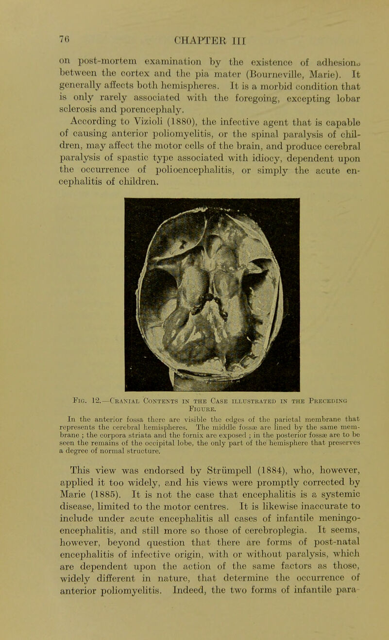 on post-mortem examination by the existence of adhesiono between the cortex and the pia mater (Bourneville, Marie). It generally affects both hemispheres. It is a morbid condition that is only rarely associated with the foregoing, excepting lobar sclerosis and porencephaly. According to VizioH (1880), the infective agent that is capable of causing anterior poliomyelitis, or the spinal paralysis of chil- dren, may affect the motor cells of the brain, and produce cerebral paralysis of spastic type associated with idiocy, dependent upon the occurrence of polioencephalitis, or simply the acute en- cephalitis of children. Fig. 12.—Cranial Contents in the Case illustrated in the Preceding Figure. In the anterior fossa there are visible the edges of the parietal membrane that represents the cerebral hemispheres. The middle fossaj are lined by the same mem- brane ; the corpora striata and the fornix arc exposed ; in the posterior fossa3 are to bo seen the remains of the occipital lobe, the only part of the hemisphere that preserves a degree of normal structure. This view was endorsed by Striimpell (1884), who, however, applied it too widely, and his views were promptly corrected by Marie (1885). It is not the case that encephahtis is a systemic disease, limited to the motor centres. It is likewise inaccurate to include under acute encephalitis all cases of infantile meningo- encephalitis, and still more so those of cerebroplegia. It seems, however, beyond question that there are forms of post-natal encephalitis of infective origin, with or without paralysis, Avhich are dependent upon the action of the same factors as those, widely different in nature, that determine the occurrence of anterior poliomyelitis. Indeed, the two forms of infantile para-