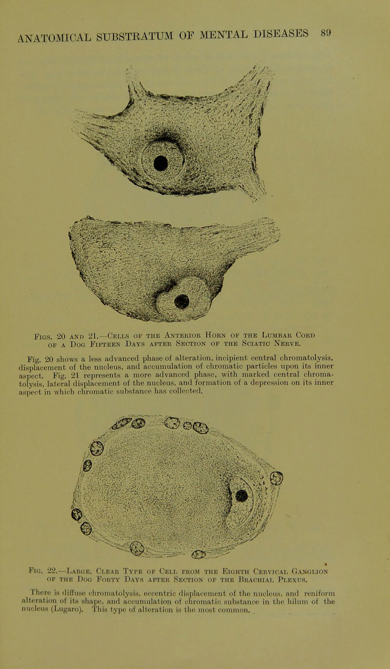 Figs. 20 ajtd 21.—Cells of the Anterior Horn of the Lumbar Cord OF A Dog Fifteen Days after Section of the Sciatio Nerve. Fig. 20 shows a less advanced phase of alteration, incipient central chromatolysis, displacement of the nucleus, and accumulation of chromatic particles upon its inner aspect. Fig. 21 represents a more advanced phase, with marlvcd central chroma- tolysis, lateral displacement of the nucleus, and formation of a depression on its inner aspect in which chromatic substance has collected. m Fio. 22.—Large, Clear Type of Cell from the Eighth Cervical Gaj^glion of the Dog Forty Days after Section of the Brachial Plexus. There is <lifTuso chromatolysis, eccentric displacement of the nuckMis. and rcuiforin alteration of its shape, and accumulation of chromatic substance in the liihini of the nucleus (Lugaro). This type of alteration is the most common.