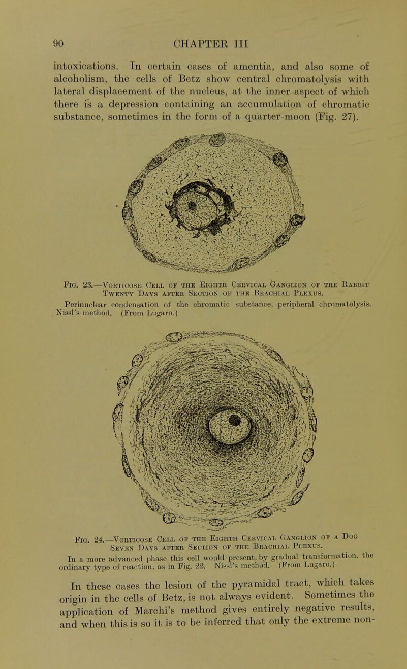 intoxications. In certain cases of amentia, and also some of alcoholism, the cells of Betz show central chromatolysis with lateral displacement of the nucleus, at the inner aspect of which there is a depression containing an accumulation of chromatic substance, sometimes in the form of a quarter-moon (Fig. 27). Fig. 23.—Vorticose Cell of the Eighth Cervical Ganglion of the Rabbit Twenty Days after Section of the Brachial Plexus. Perinuclear condensation of the chromatic substance, peripheral chromatolysis. Nissl's method. (From Lugaro.) Fig. 24. Vorticose Cell of the Eighth Cervical Ganglion of a Dog Seven Days after Section of the Brachial Plexus. In a more advanced phase this cell would present, by gradual transformation, the ordinary typo of reaction, as in Fig. 22. Nissl's method. (From Lugaro.) In these cases the lesion of the pyramidal tract, which takes origin in the cells of Betz, is not always evident. Sometimes the application of Marchi's method gives entirely negative results, and when this is so it is to be inferred that only the extreme non-