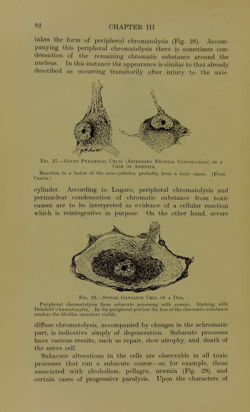 takes the form of peripheral chromatolysis (Fig. 28). Accom- panying this peripheral chromatolysis there is sometimes con- densation of the remaining chromatic substance around the nucleus. In this instance the appearance is similar to that already described as occurring transitorily after injury to the axis- FiG. 27.—Giant Pyramidal Cells (Ascending Frontal Convolution) in a Case of Amentia. Reaction to a lesion of the axis-cylinder, probably from a toxic cause. (From Camia.) cylinder. According to Lugaro, peripheral chromatolysis and perinuclear condensation of chromatic substance from toxic causes are to be interpreted as evidence of a cellular reaction which is reintegrative in purpose. On the other hand, severe Fig. 28.—Spinal Ganglion Cell of a Dog. Peripheral chromatolysis from subacute poisoning with arsenic. Staining with Delaiield's hsematoxylin. In the peripheral portion the loss of the chromatic substance renders the fibrillar structure visible, diffuse chromatolysis, accompanied by changes in the achromatic part, is indicative simply of degeneration. Subacute processes have various results, such as repair, slow atrophy, and death of the nerve cell. Subacute alterations in the cells are observable in all toxic processes that run a subacute course—as, for example, those associated with alcoholism, pellagra, urtemia (Fig. 29), and certain cases of progressive paralysis. Upon the characters of