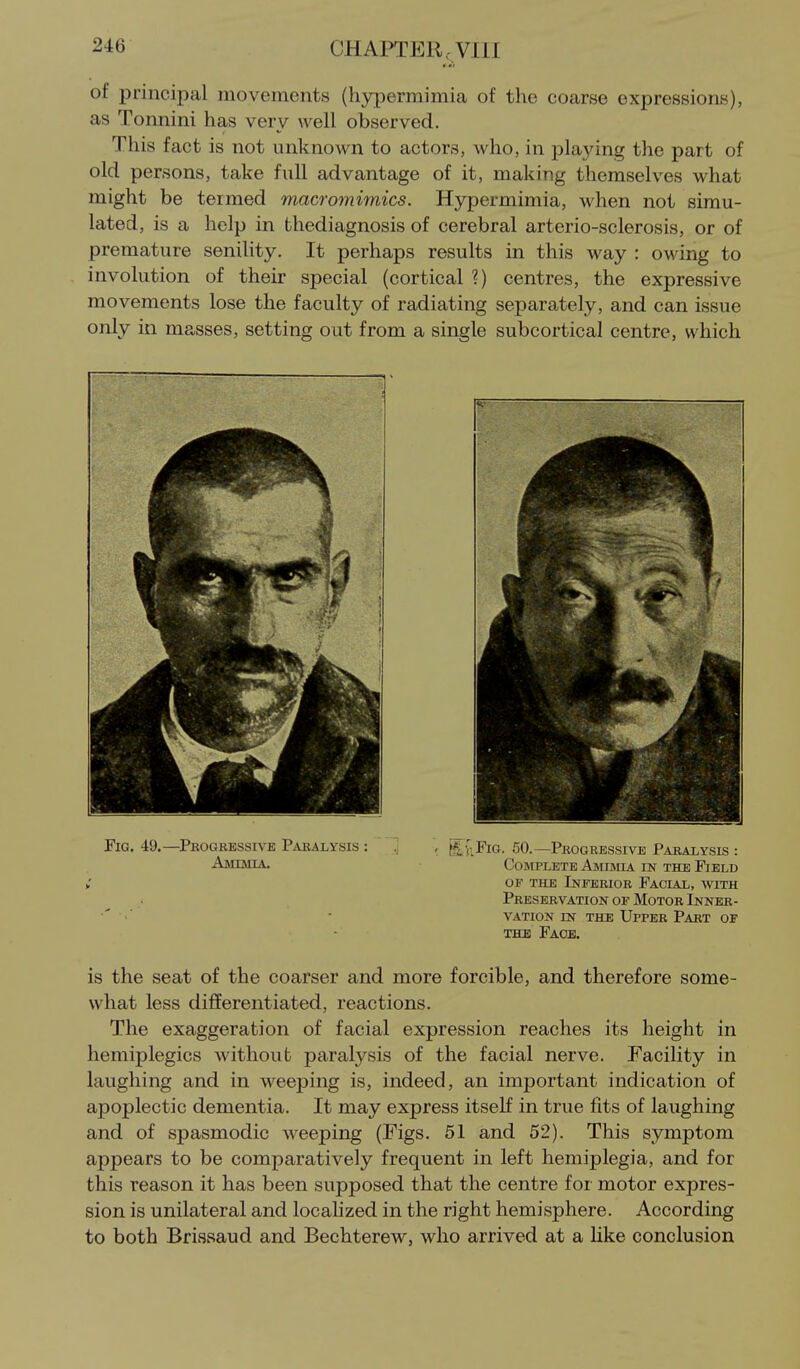 of principal movements (hyjiermimia of the coarse expressions), as Tonnini has very well observed. This fact is not unknown to actors, who, in playing the part of old persons, take full advantage of it, making themselves what might be termed macromimics. Hypermimia, when not simu- lated, is a help in thediagnosis of cerebral arterio-sclerosis, or of premature senility. It perhaps results in this way : owing to involution of their special (cortical ?) centres, the expressive movements lose the faculty of radiating separately, and can issue only in masses, setting out from a single subcortical centre, which Fig. 49.—Pbogressive Pakalysis : Amimia. ffi.{;FiG. 50.—Progressive Paralysis : Complete Amumia in the Field OF the Lstfebiob Facial, with Preservation of Motor Inner- vation IN THE Upper Part of THE Face. is the seat of the coarser and more forcible, and therefore some- what less differentiated, reactions. The exaggeration of facial expression reaches its height in hemiplegics without paralysis of the facial nerve. Facility in laughing and in weeping is, indeed, an important indication of apoplectic dementia. It may express itself in true fits of laughing and of spasmodic weeping (Figs. 51 and 52). This symptom appears to be comparatively frequent in left hemiplegia, and for this reason it has been supposed that the centre for motor expres- sion is unilateral and locahzed in the right hemisphere. According to both Brissaud and Bechterew, who arrived at a like conclusion