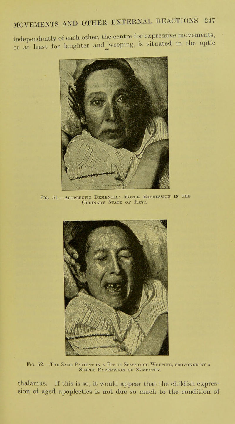independently of each other, the centre for expressive movements, or at least for laughter and_Jweeping, is situated in the optic Fig. 51.—Apoplectic Dementia: Motor Expression in the Ordinary State of Rest. Fio. 52.:—The Same Patient in a Fit of Spasmodic Weeping, provoked by a Simple Expression of Sympathy. thalamus. If this is so, it would appear that the childish expres- sion of aged apoplectics is not due so much to the condition of