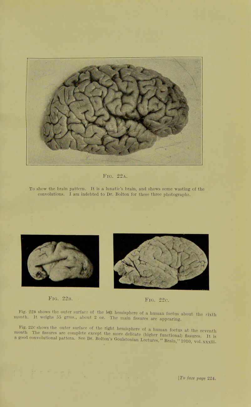 Fig. 22b. Fif,'. 22 c. Fig. 22B shows the oilier surface of the left hemisphere of a Imiuan foetus about the ^ixlh ruonlh. Jt weighs .15 grins., ulmut 2 oz. Tlie main fissures are appearing. Fig 220 shows the outer surface of tlie right lien.isphere of a liumiui foetus at tiio <:cvcntli month The fissures are eoiuplete except the more delicate (Higher functional) flssl es T is a good convolnfonal pattern. .See Dr. Jiolton's Goulstonian Lectures,  Bniin' • 910 vo 1 xxxii