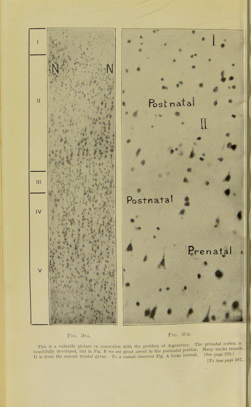 V Ftci. oOa. N * * • i ■ Post natal IL Postnatal J « I i. IJrenat^al i Fig. nOB. ThiH is a valuable picture in coniioxion with tlic problem of dcgcnciacy. liic picnatal tortcx b(,autifiiliy tluvclopcil, but ill I'Mg. ii wu kco great arrest in the postnatal portion. Many nucltn remiuu. It is from tlic second fronlal gyrus. 'L'o a casual (il)server Fig. A looks normal. (hue page ^( ■)