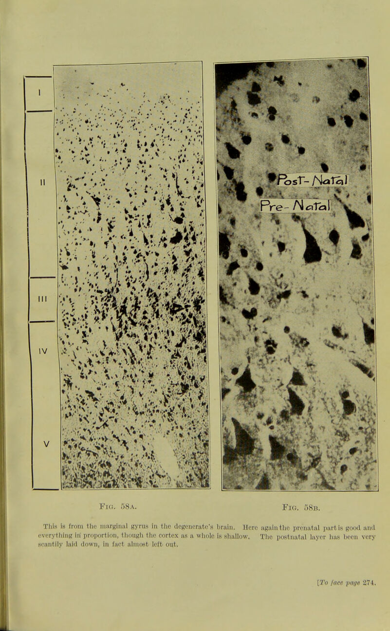 Fig. 58a. Fig. 58b. Tliis is from the. iiiiirKiiml Ryrus in the degenerate's brain. Hero again the prenatal partis good and (ivorything in proportion, tliougli tlic cortex as a whole is sliallow, Tlie postnatal layer has been very scantily laid down, in fact almost left out.