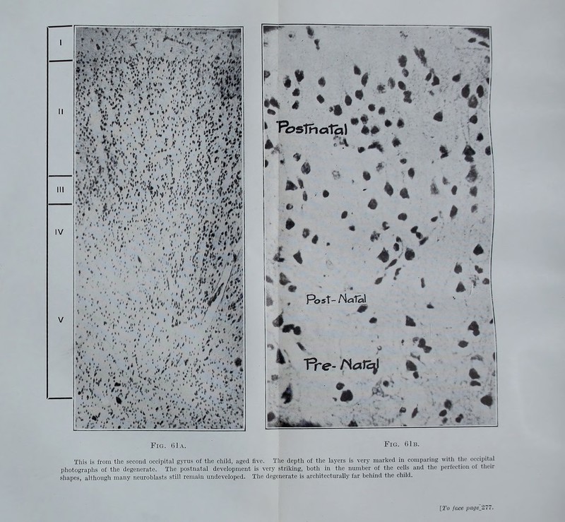 V ■ , .W , ... '< / it.. ', ' , ' ' Fig. 61a. %4 * » t * i. ft V f 4 Post- Fig. GlB. This is from the second occipital gyrus of the child, aged five. The depth of the layers is very marked in comparmg with the occipital photograplis of the degenerate. The postnatal development is very striking, both in the number of the cells and the perfection of their shapes, although many neuroblasts still remain undeveloped. The degenerate is architecturally far behind the child. [To face pagej.'t7.