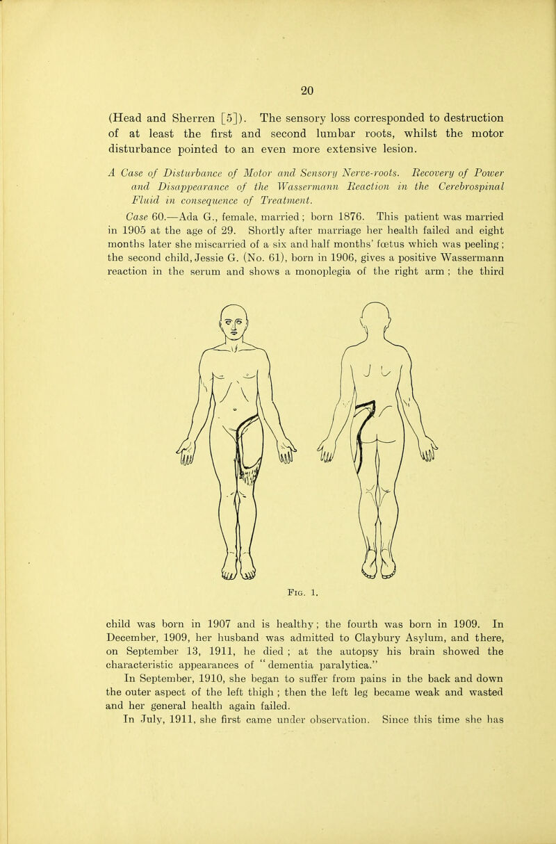 (Head and Sherren [5]). The sensory loss corresponded to destruction of at least the first and second lumbar roots, whilst the motor disturbance pointed to an even more extensive lesion. A Case of Disturbance of Motor and Sensory Nerve-roots. Recovery of Poiver and Disappearance of the Wassermann Reaction in the Cerebrospinal Fluid in consequence of Treatment. Case 60.—Ada G., female, married; born 1876. This patient was married in 1905 at the age of 29. Shortly after marriage her health failed and eight months later she miscarried of a six and half months' foetus which was peeling ; the second child, Jessie G. (No. 61), born in 1906, gives a positive Wassermann reaction in the serum and shows a monoplegia of the right arm ; the third Fig. 1. child was born in 1907 and is healthy ; the fourth was born in 1909. In December, 1909, her husband was admitted to Claybury Asylum, and there, on September 13, 1911, he died ; at the autopsy his brain showed the characteristic appearances of  dementia paralytica. In September, 1910, she began to suffer from pains in the back and down the outer aspect of the left thigh ; then the left leg became weak and wasted and her general health again failed. In Tuly, 1911, she first came under observation. Since tliis time she has