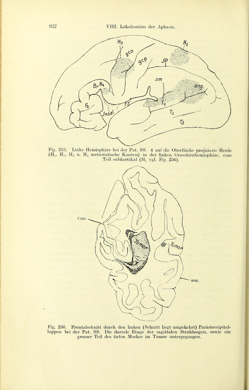 Fig. 2.55. Linke Hemisphäre bei der Pat. SS. 4 auf die Oberfläche projizierte Herde (Hl, Ho, H3 u. H4 metastatische Knoten) in der linken Grosshirnhemisphäre, zum Teil subkortikal (H, vgl. Fig. 256). Fig. 256. Frontalschnitt durch den linken (Schnitt liegt umgekehrt) Parietoccipital- lappen bei der Pat. SS. Die dorsale Etage der sagittalen Strahlungen, sowie ein grosser Teil des tiefen Markes im Tumor untergegangen.