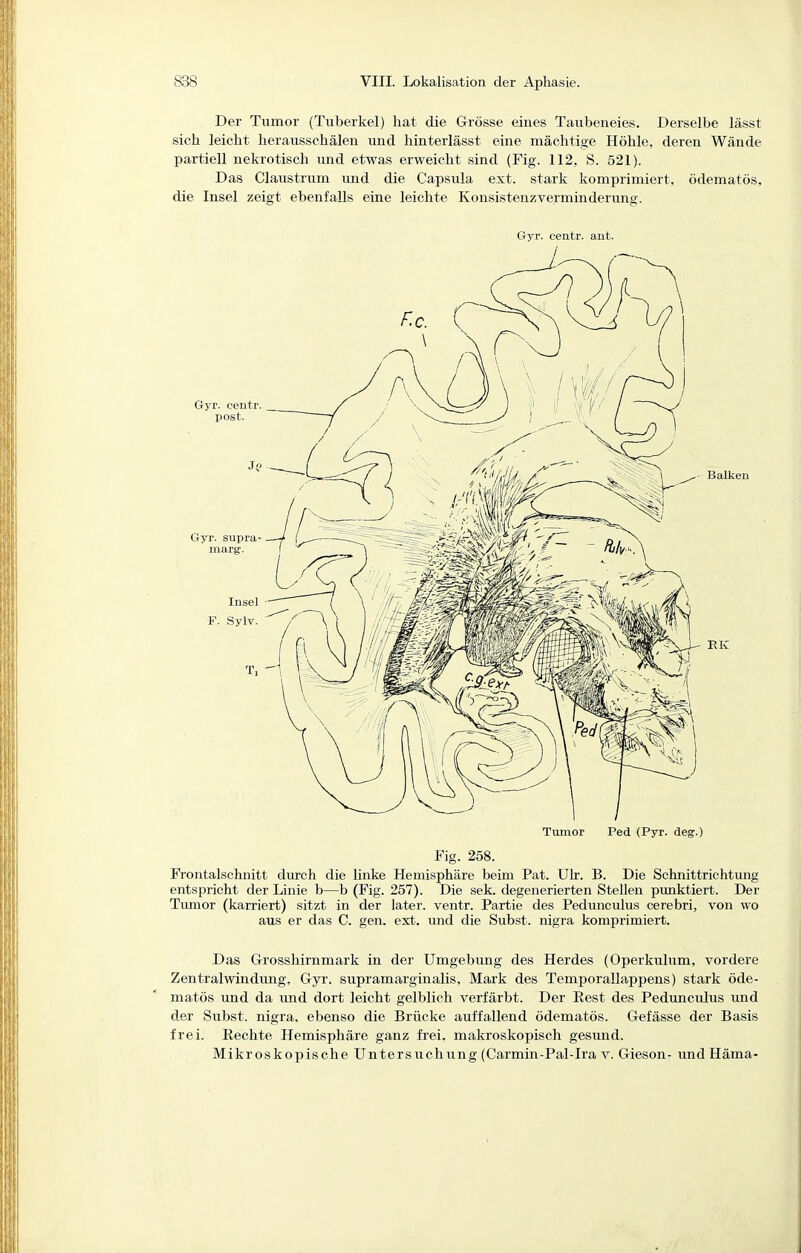 Der Tumor (Tuberkel) hat die Grösse eines Taubeneies. Derselbe lässt sich leicht herausschälen und hinterlässt eine mächtige Höhle, deren Wände partiell nekrotisch und etwas erweicht sind (Fig. 112, S. 521). Das Claustrum und die Capsula ext. stark komprimiert, ödematös, die Insel zeigt ebenfalls eine leichte Konsistenzverminderung. Gyr. centr. ant. Tumor Ped (Pyr. deg.) Fig. 258. Frontalschnitt durch die linke Hemisphäre beim Pat. Ulr. B. Die Schnittrichtung entspricht der Linie b—b (Fig. 257). Die sek. degenerierten Stellen punktiert. Der Tumor (karriert) .sitzt in der later. ventr. Partie des Pedunculus cerebri, von wo aus er das C. gen. ext. und die Subst. nigra komprimiert. Das Grrosshirnmark in der Umgebung des Herdes (Operkulum, vordere Zentralwindimg, Gjr. supramarginalis, Mark des Temporallappens) stark öde- matös und da und dort leicht gelblich verfärbt. Der Rest des Pedunculus und der Subst. nigra, ebenso die Brücke auffallend ödematös. Gefässe der Basis frei. Rechte Hemisphäre ganz frei, makroskopisch gesund. Mikroskopische Untersuchung (Carmin-Pal-Ira v. Giesen- undHäma-