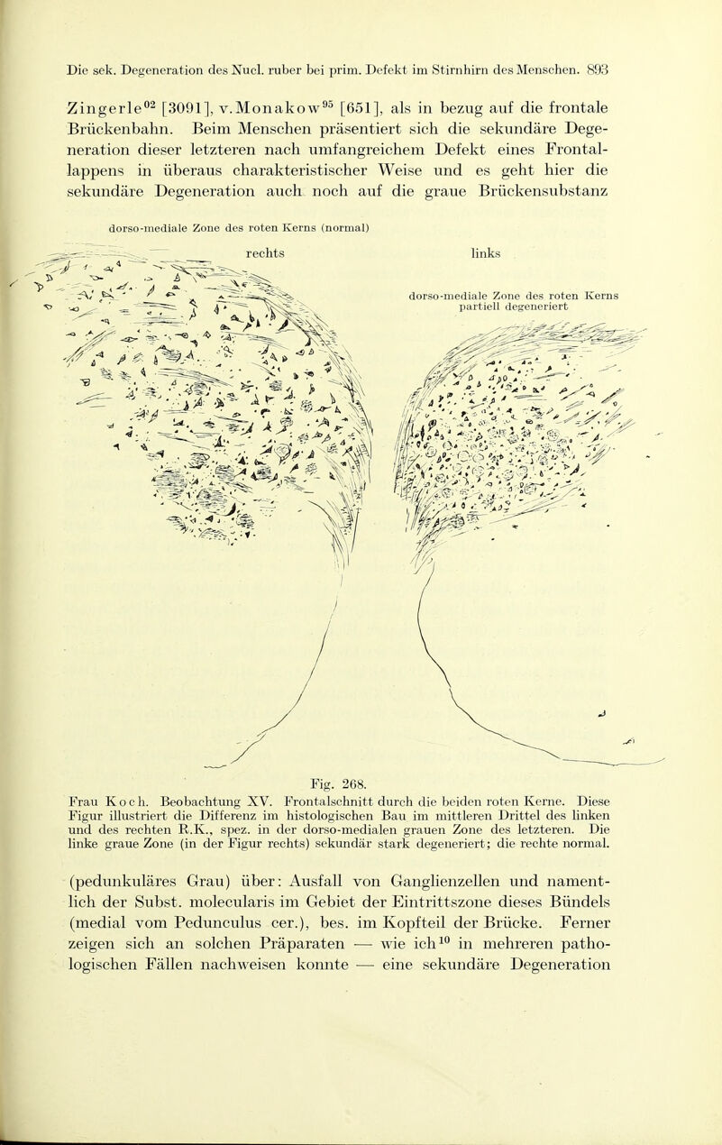Zingerle^ [3091], v.Monakow^^ [651], als in bezug auf die frontale Brückenbahn. Beim Menschen präsentiert sich die sekundäre Dege- neration dieser letzteren nach umfangreichem Defekt eines Frontal- lappens in überaus charakteristischer Weise und es geht hier die sekundäre Degeneration auch noch auf die graue Brückensubstanz dorso-mediale Zone des roten Kerns (normal) Fig. 268. Frau Koch. Beobachtung XV. Frontalschnitt durcli die beiden roten Kerne. Diese Figur illustriert die Differenz im histologischen Bau im mittleren Drittel des linken und des rechten U.K., spez. in der dorso-medialen grauen Zone des letzteren. Die linke graue Zone (in der Figur rechts) sekundär stark degeneriert; die rechte normal. (pedunkuläres Grau) über: Ausfall von Ganglienzellen und nament- lich der Subst. molecularis im Gebiet der Eintrittszone dieses Bündels (medial vom Pedunculus cer.), bes. im Kopfteil der Brücke. Ferner zeigen sich an solchen Präparaten — wie ich^ in mehreren patho- logischen Fällen nachweisen konnte — eine sekundäre Degeneration